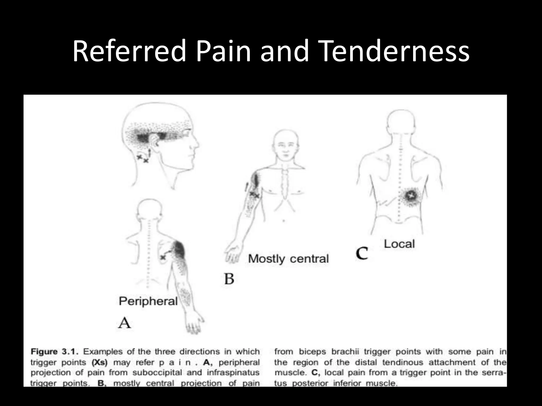 Referred Pain and Tenderness
 