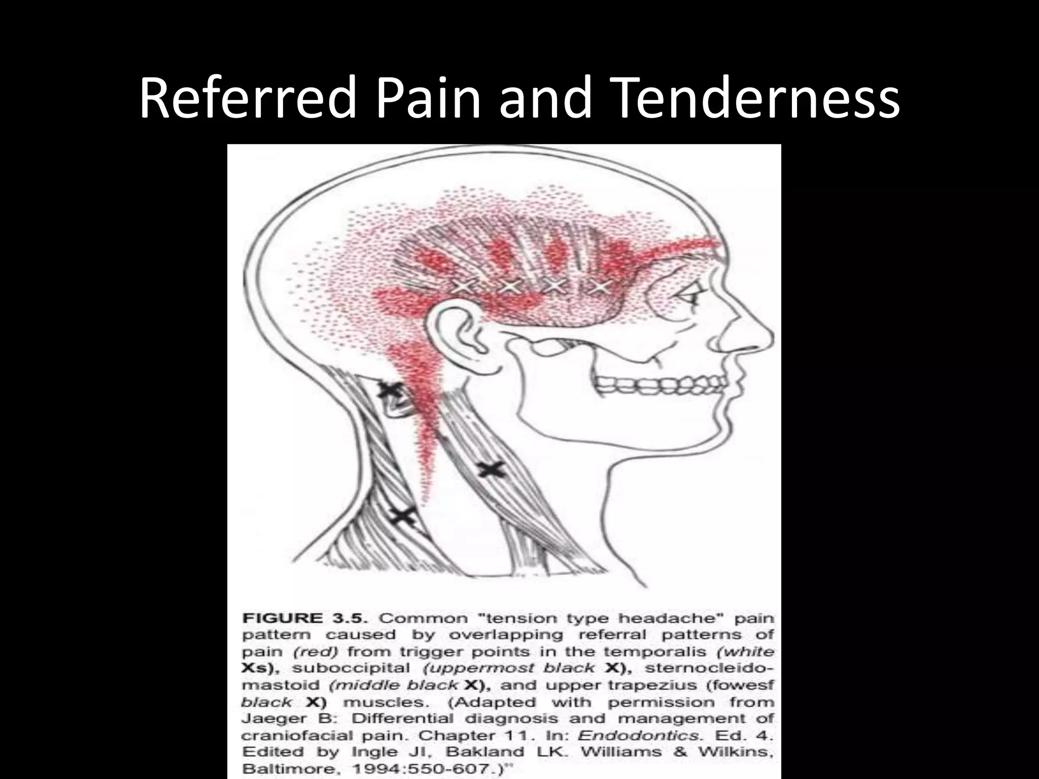 Referred Pain and Tenderness
 