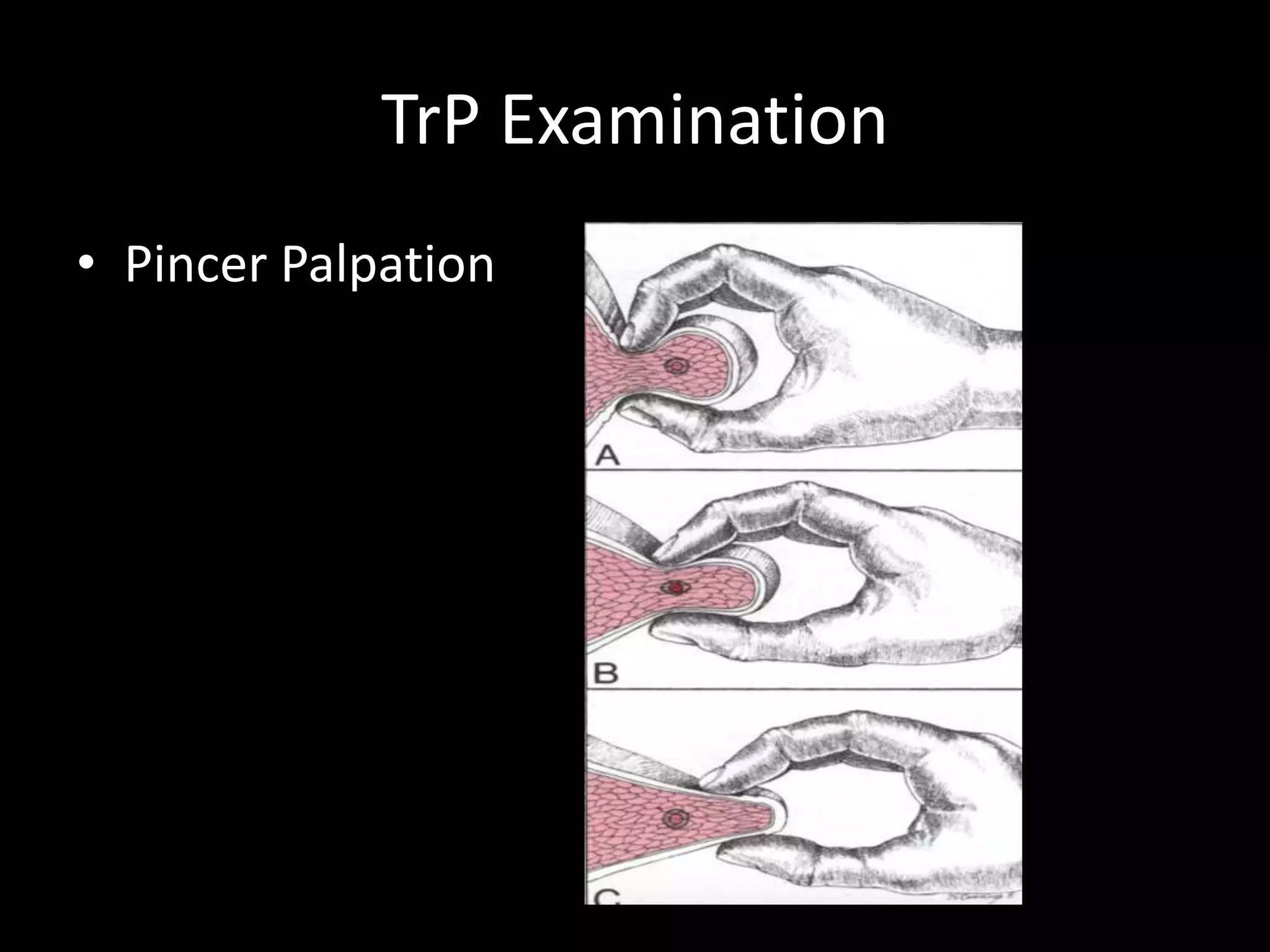 TrP Examination
• Pincer Palpation
 