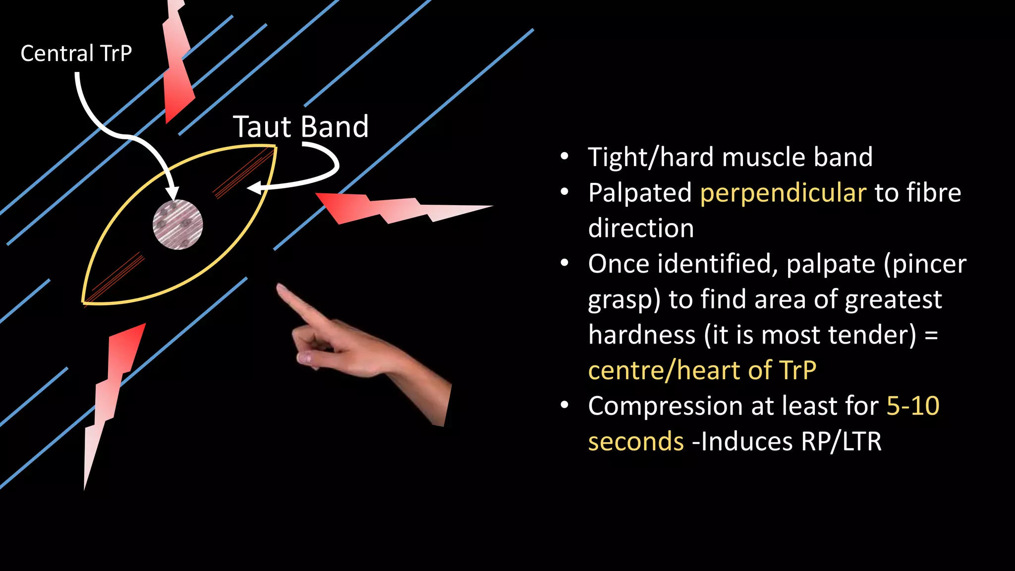 Taut Band
Central TrP
• Tight/hard muscle band
• Palpated perpendicular to fibre
direction
• Once identified, palpate (pincer
grasp) to find area of greatest
hardness (it is most tender) =
centre/heart of TrP
• Compression at least for 5-10
seconds -Induces RP/LTR
 
