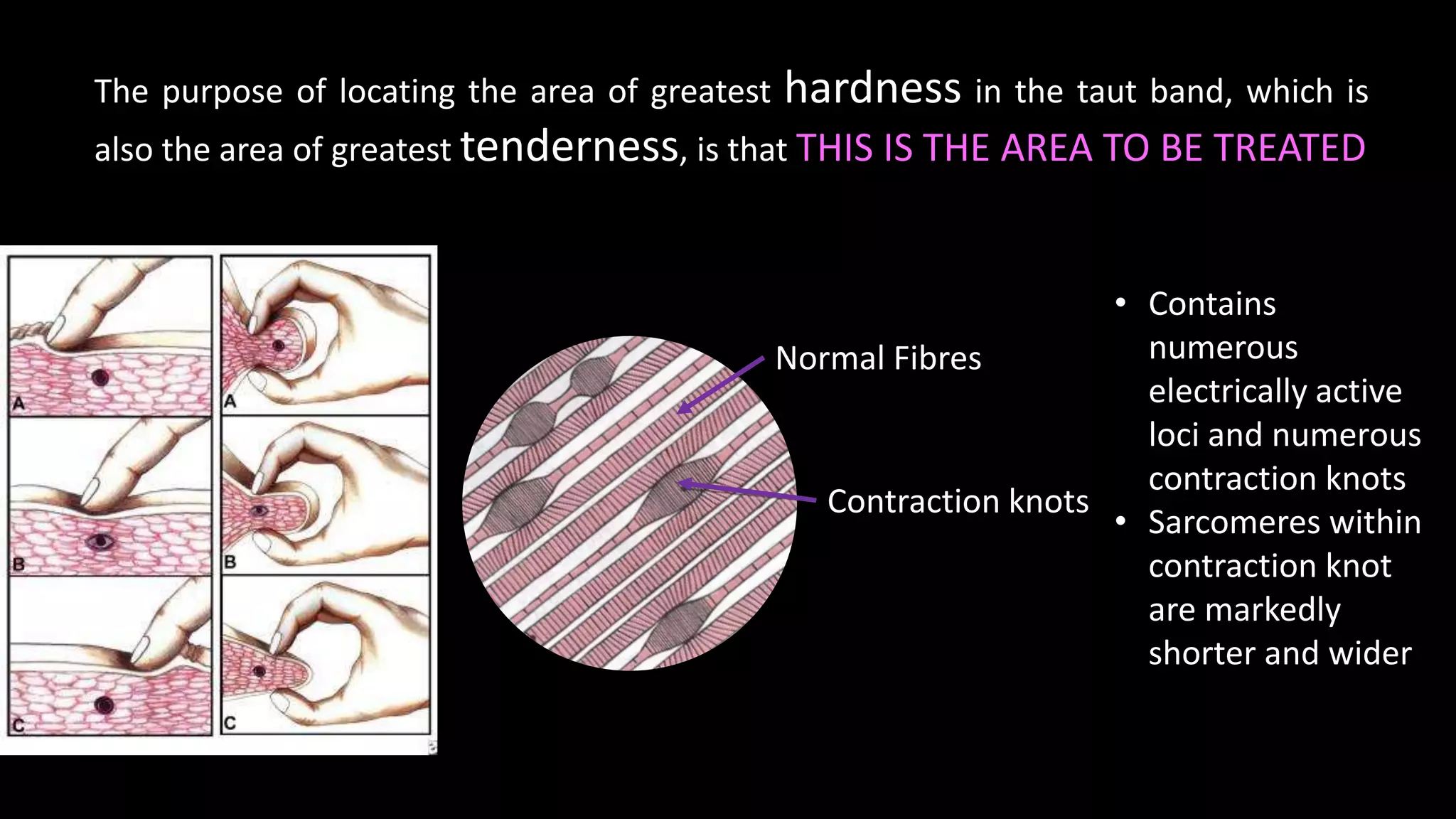 Normal Fibres
Contraction knots
The purpose of locating the area of greatest hardness in the taut band, which is
also the area of greatest tenderness, is that THIS IS THE AREA TO BE TREATED
• Contains
numerous
electrically active
loci and numerous
contraction knots
• Sarcomeres within
contraction knot
are markedly
shorter and wider
 