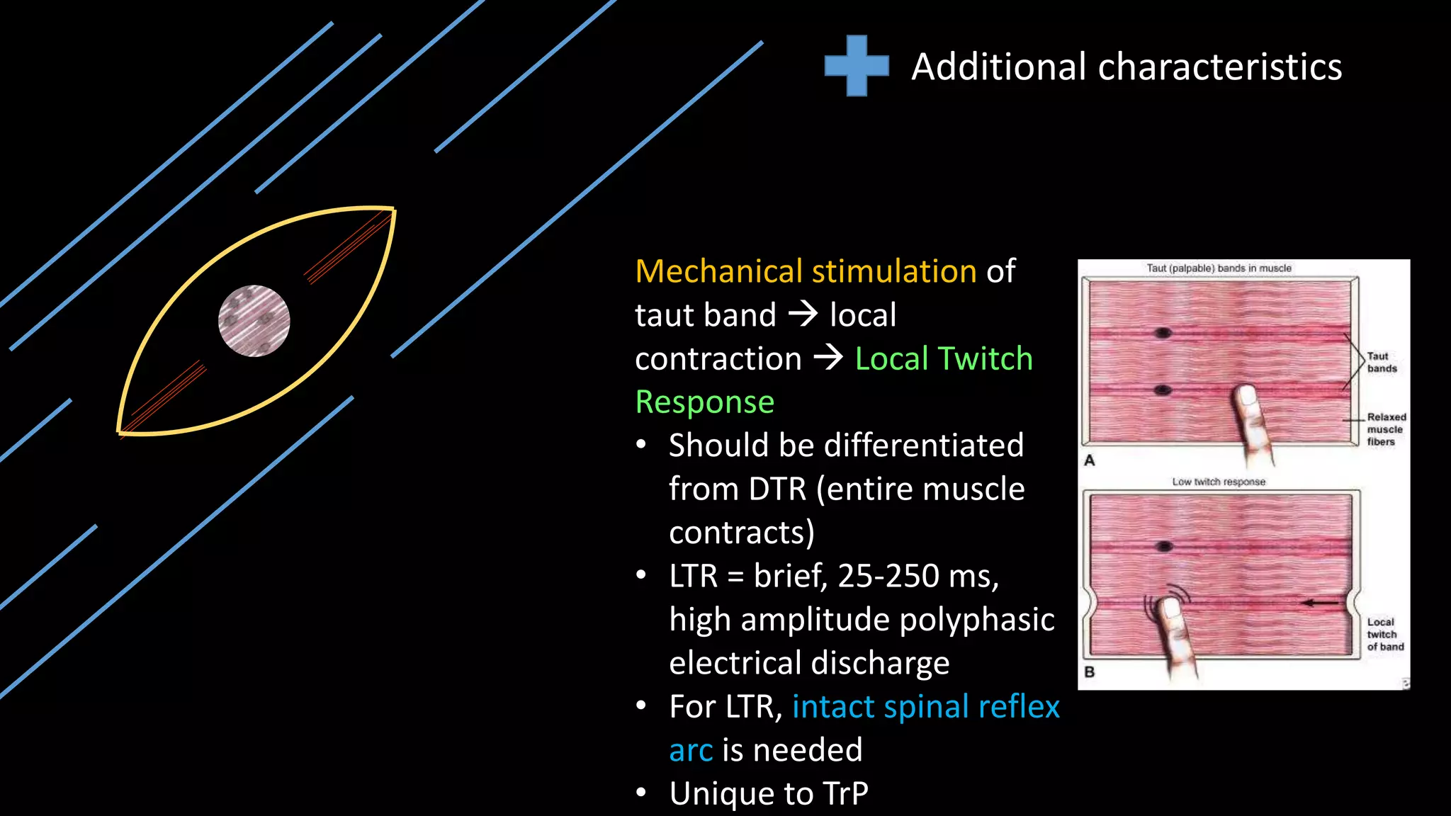Additional characteristics
Mechanical stimulation of
taut band  local
contraction  Local Twitch
Response
• Should be differentiated
from DTR (entire muscle
contracts)
• LTR = brief, 25-250 ms,
high amplitude polyphasic
electrical discharge
• For LTR, intact spinal reflex
arc is needed
• Unique to TrP
 