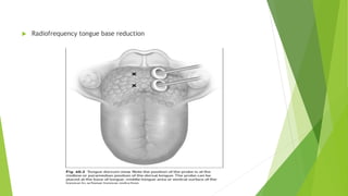  Radiofrequency tongue base reduction
 