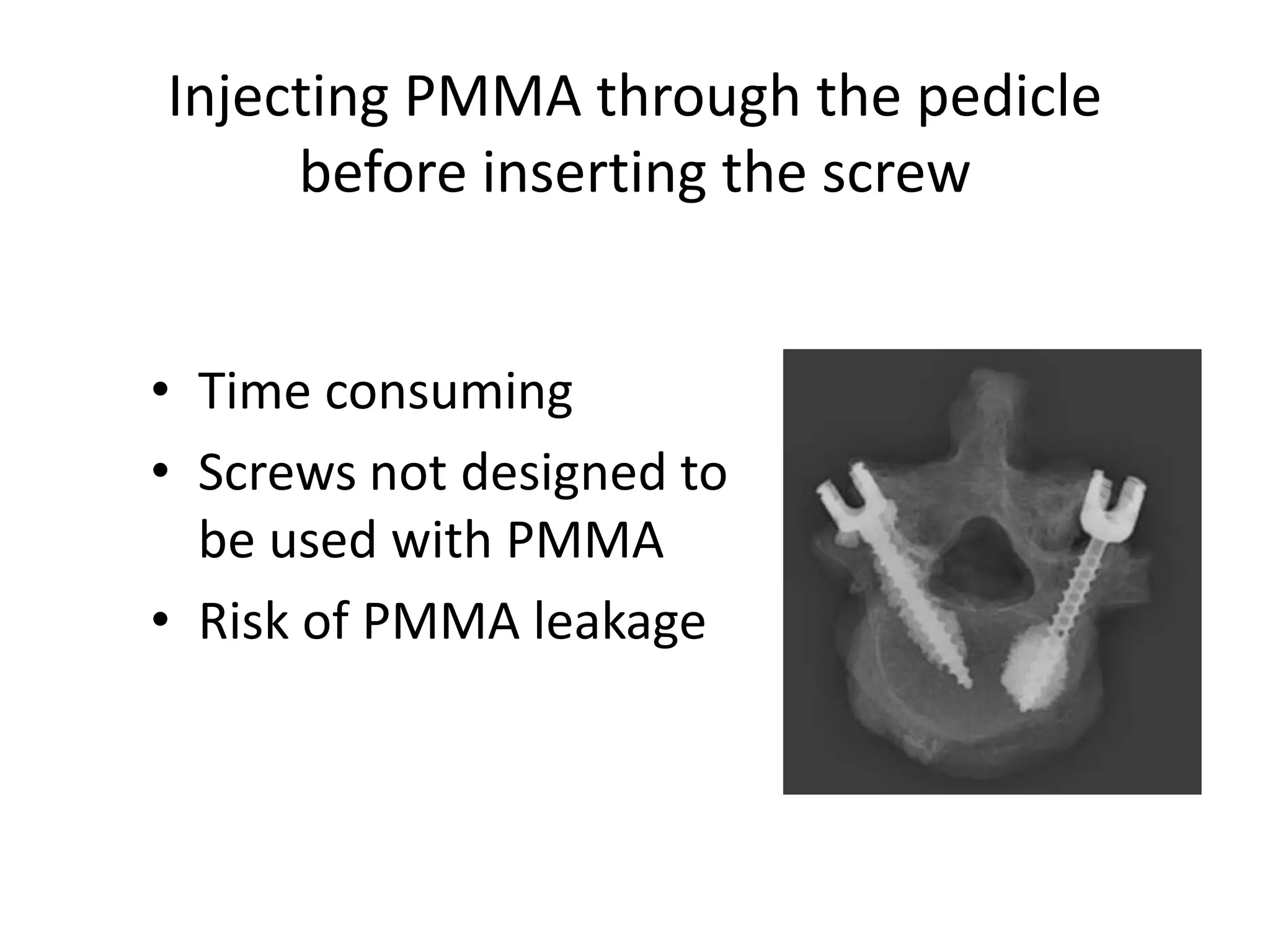 Injecting PMMA through the pedicle
before inserting the screw
• Time consuming
• Screws not designed to
be used with PMMA
• Risk of PMMA leakage
 