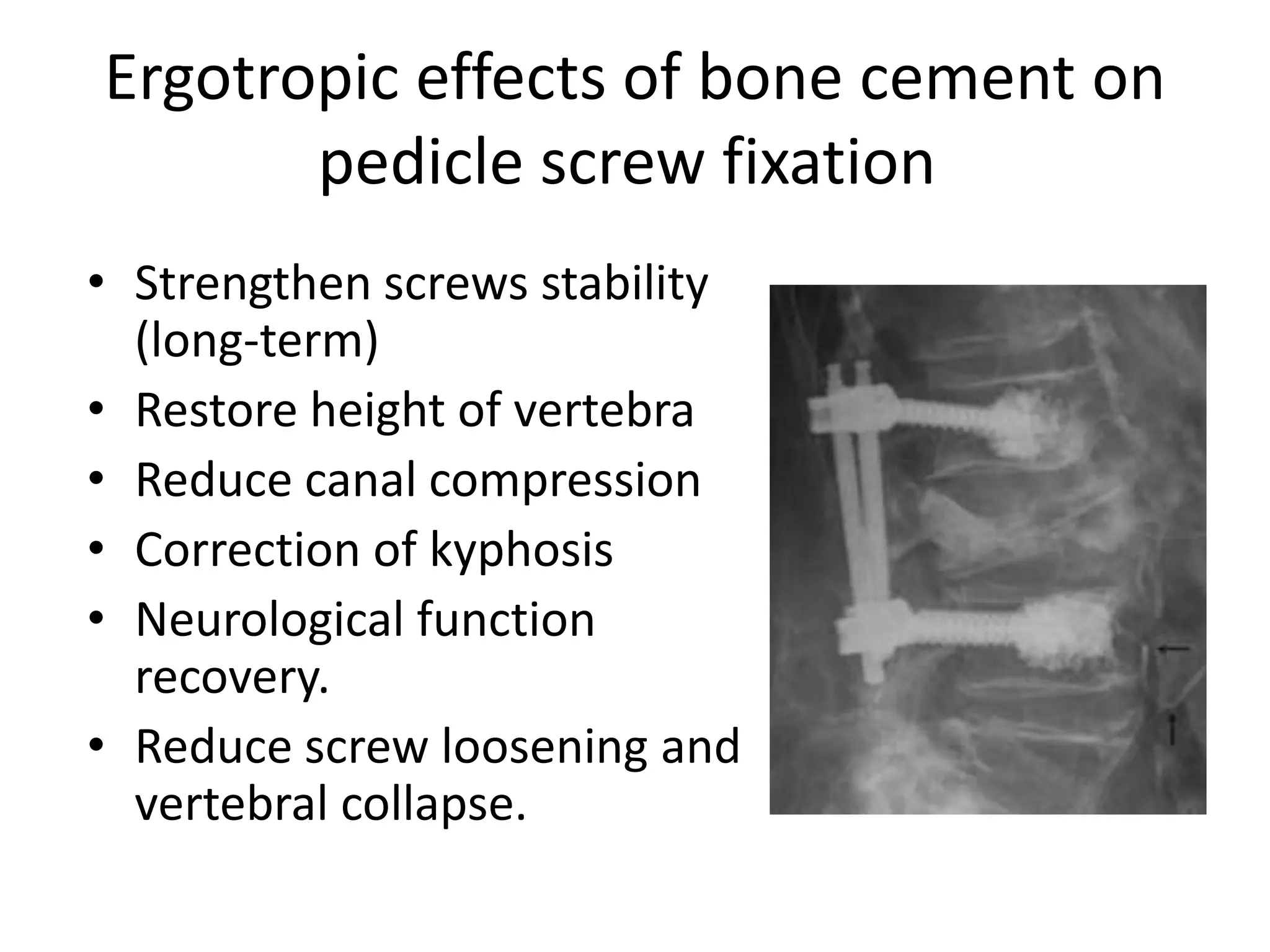 Ergotropic effects of bone cement on
pedicle screw fixation
• Strengthen screws stability
(long-term)
• Restore height of vertebra
• Reduce canal compression
• Correction of kyphosis
• Neurological function
recovery.
• Reduce screw loosening and
vertebral collapse.
 