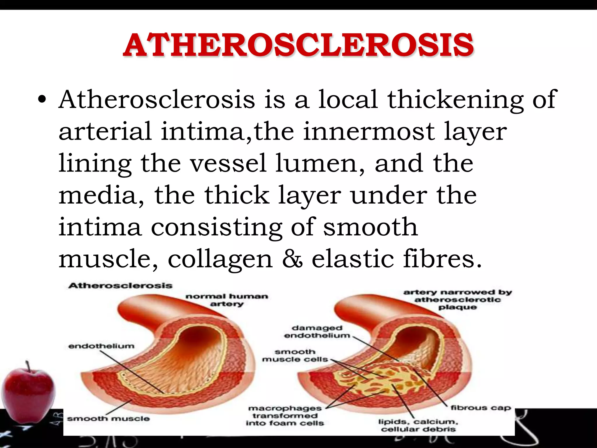 ATHEROSCLEROSIS
• Atherosclerosis is a local thickening of
arterial intima,the innermost layer
lining the vessel lumen, and the
media, the thick layer under the
intima consisting of smooth
muscle, collagen & elastic fibres.
 