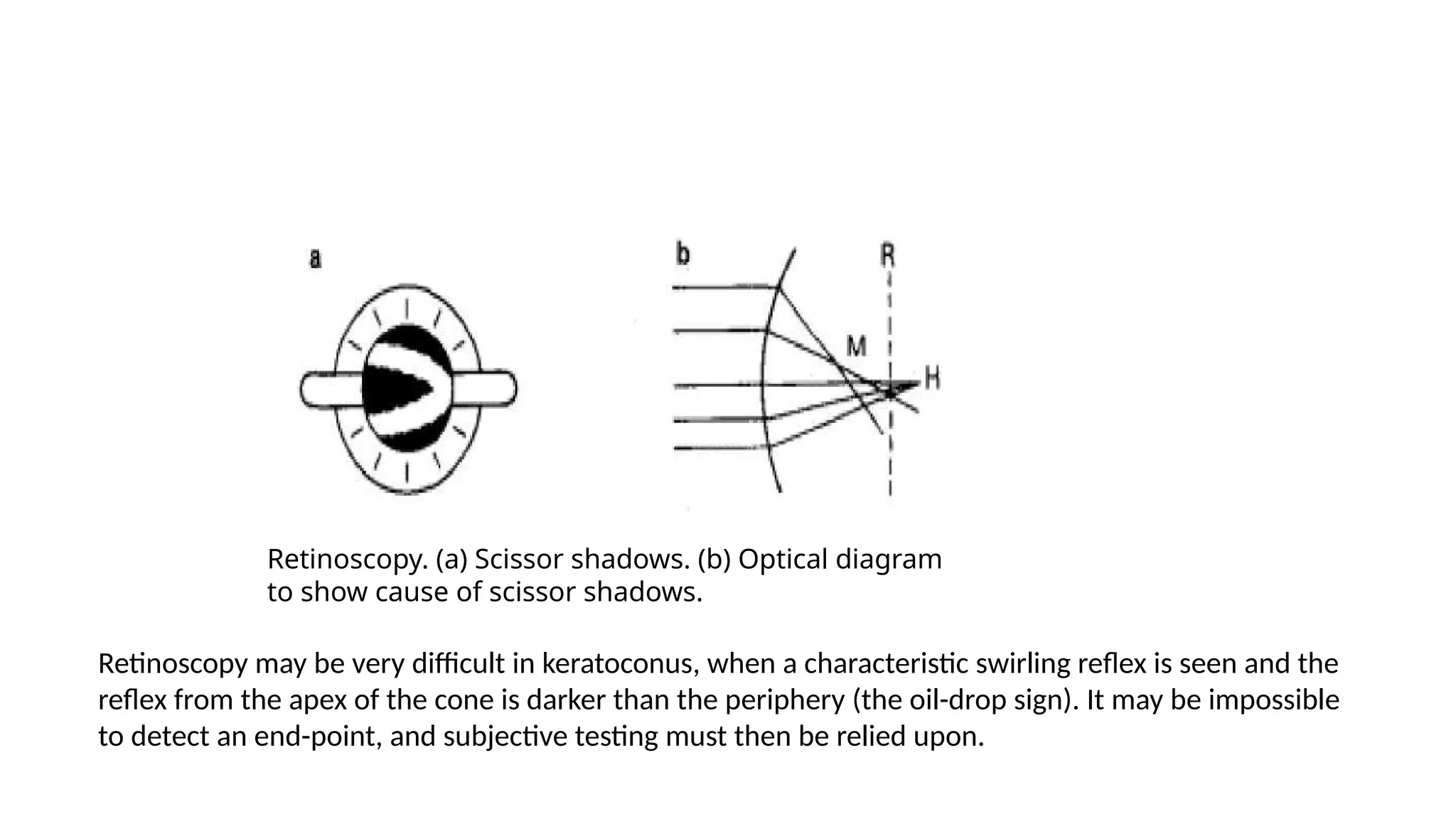 Retinoscopy. (a) Scissor shadows. (b) Optical diagram
to show cause of scissor shadows.
Retinoscopy may be very difficult in keratoconus, when a characteristic swirling reflex is seen and the
reflex from the apex of the cone is darker than the periphery (the oil-drop sign). It may be impossible
to detect an end-point, and subjective testing must then be relied upon.
 