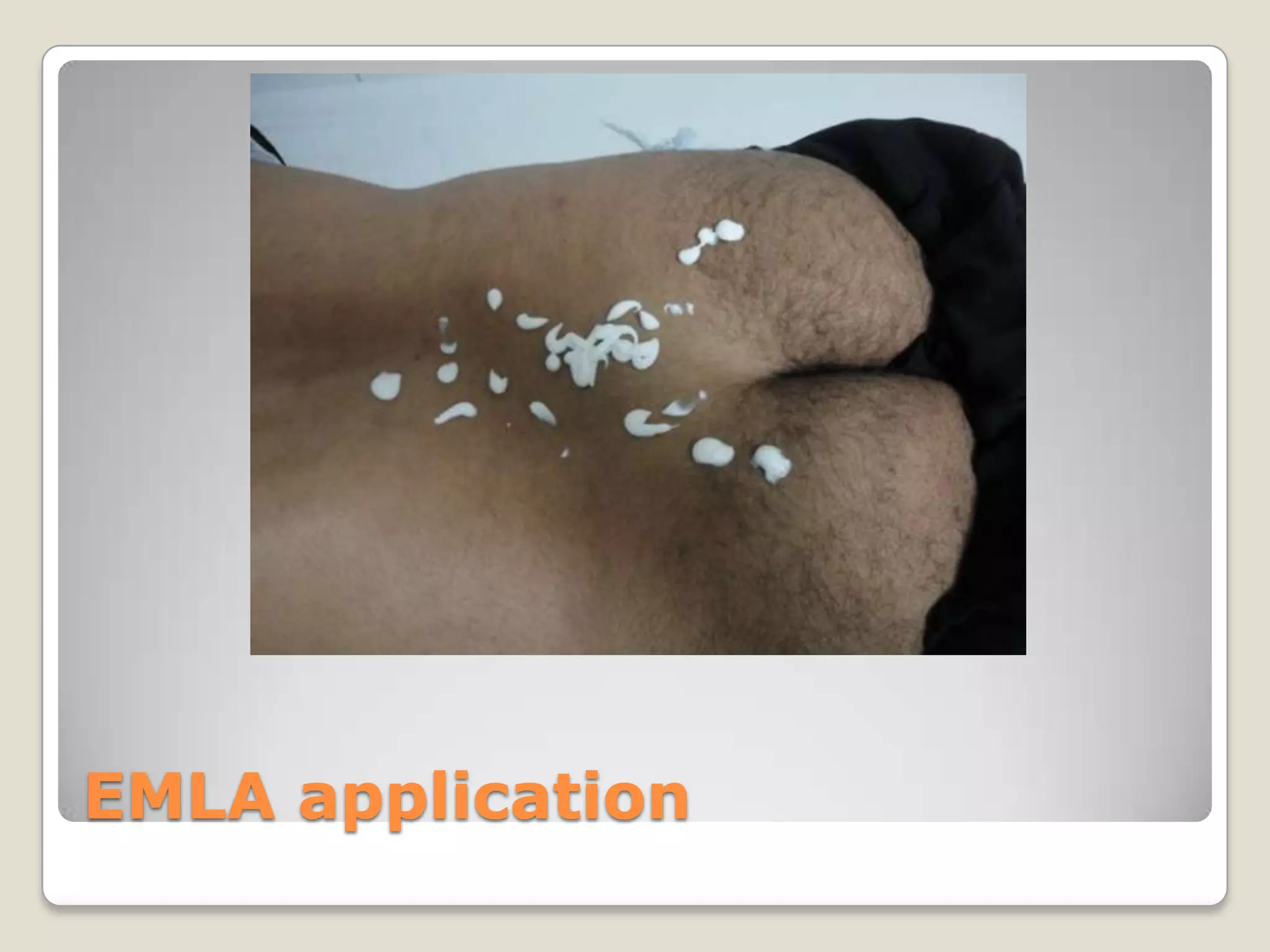 EMLA application