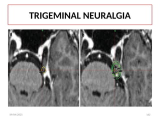 09/04/2025 162
TRIGEMINAL NEURALGIA
 