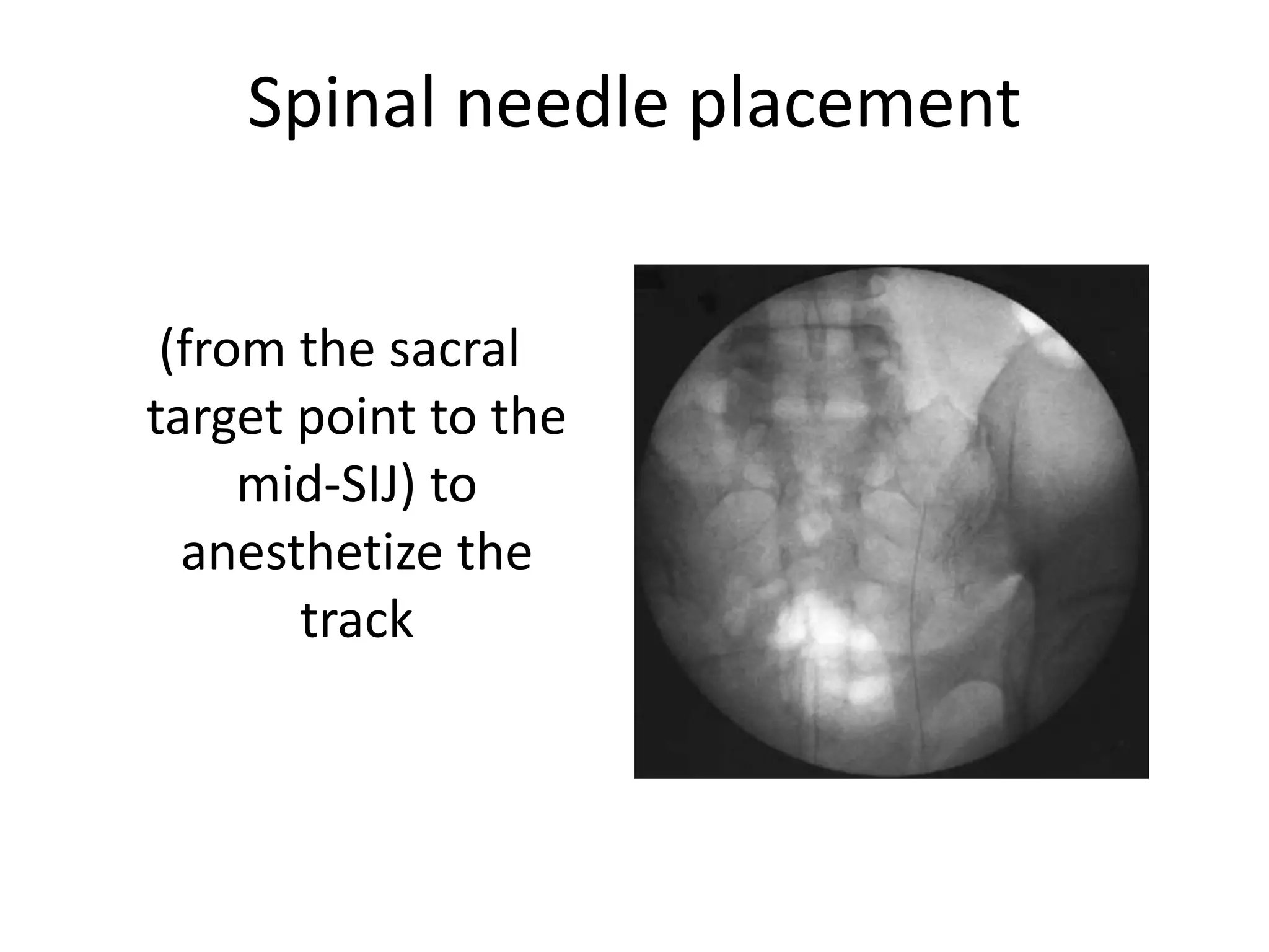 Spinal needle placement
(from the sacral
target point to the
mid-SIJ) to
anesthetize the
track
 