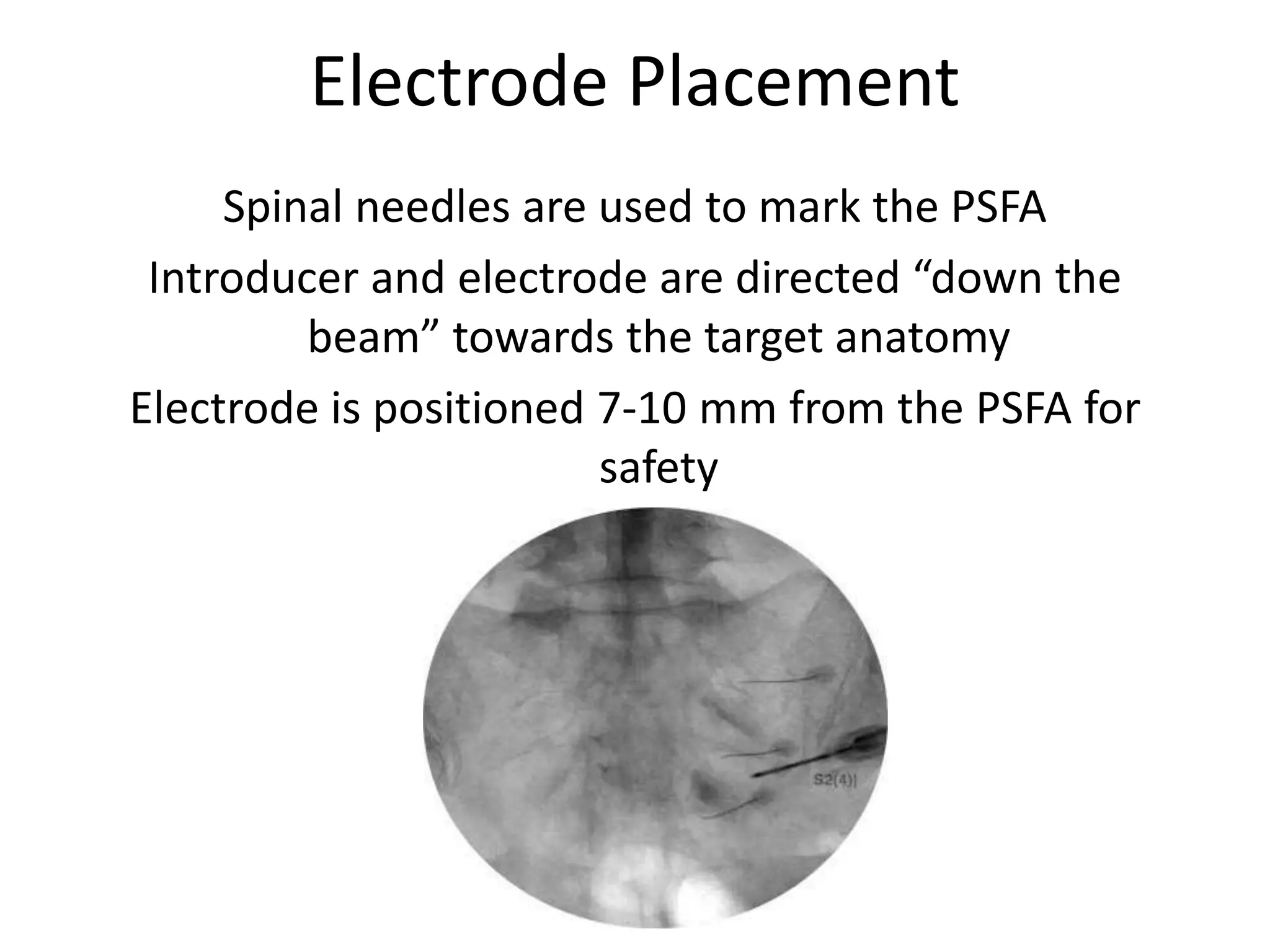 Electrode Placement
Spinal needles are used to mark the PSFA
Introducer and electrode are directed “down the
beam” towards the target anatomy
Electrode is positioned 7-10 mm from the PSFA for
safety
 