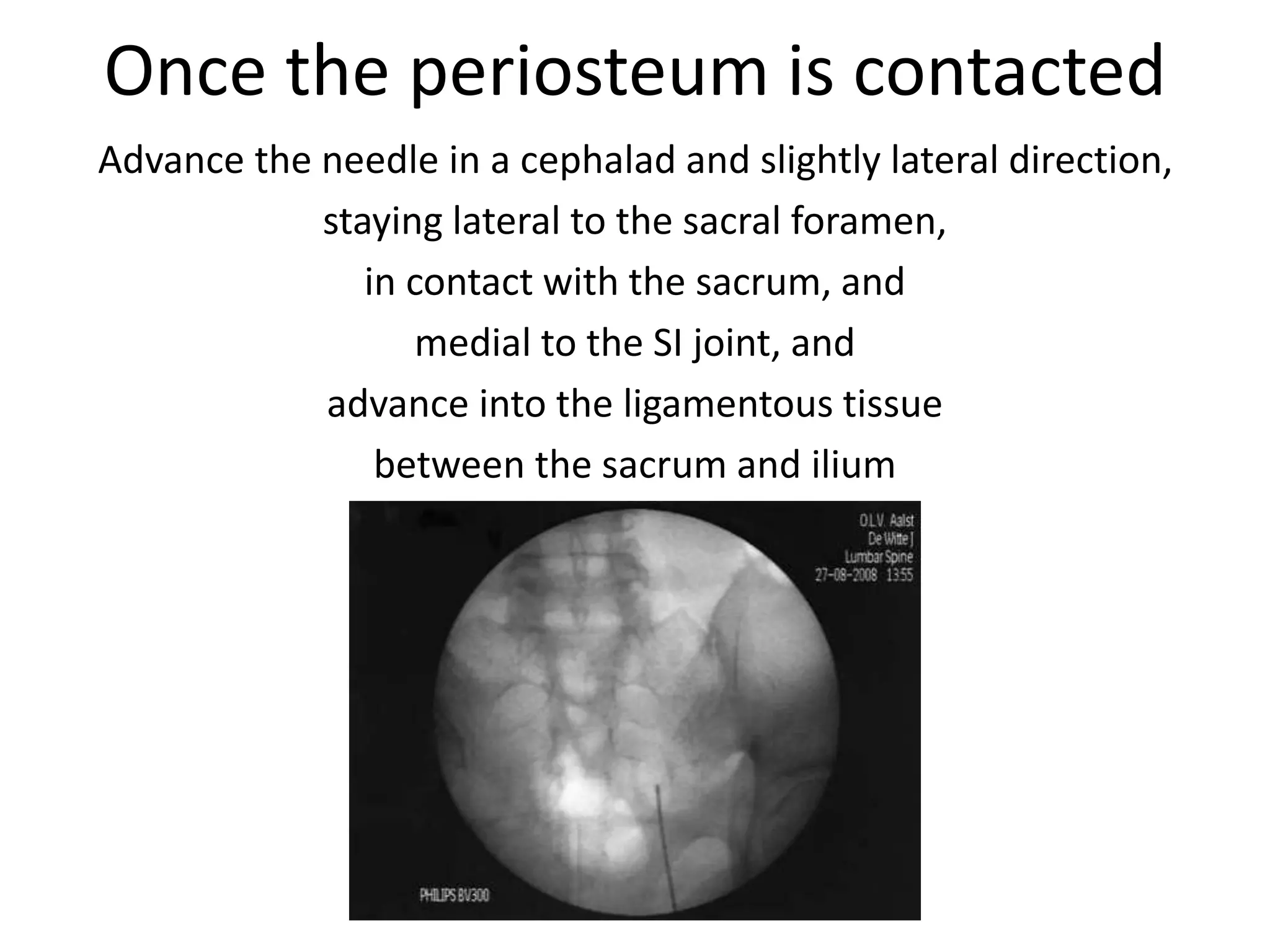 Once the periosteum is contacted
Advance the needle in a cephalad and slightly lateral direction,
staying lateral to the sacral foramen,
in contact with the sacrum, and
medial to the SI joint, and
advance into the ligamentous tissue
between the sacrum and ilium
 