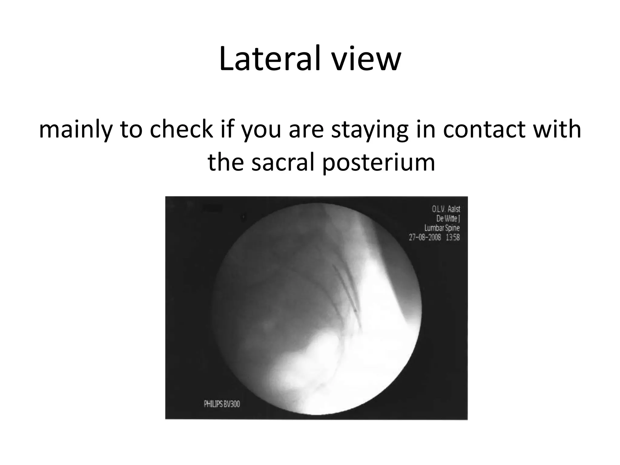 Lateral view
mainly to check if you are staying in contact with
the sacral posterium
 
