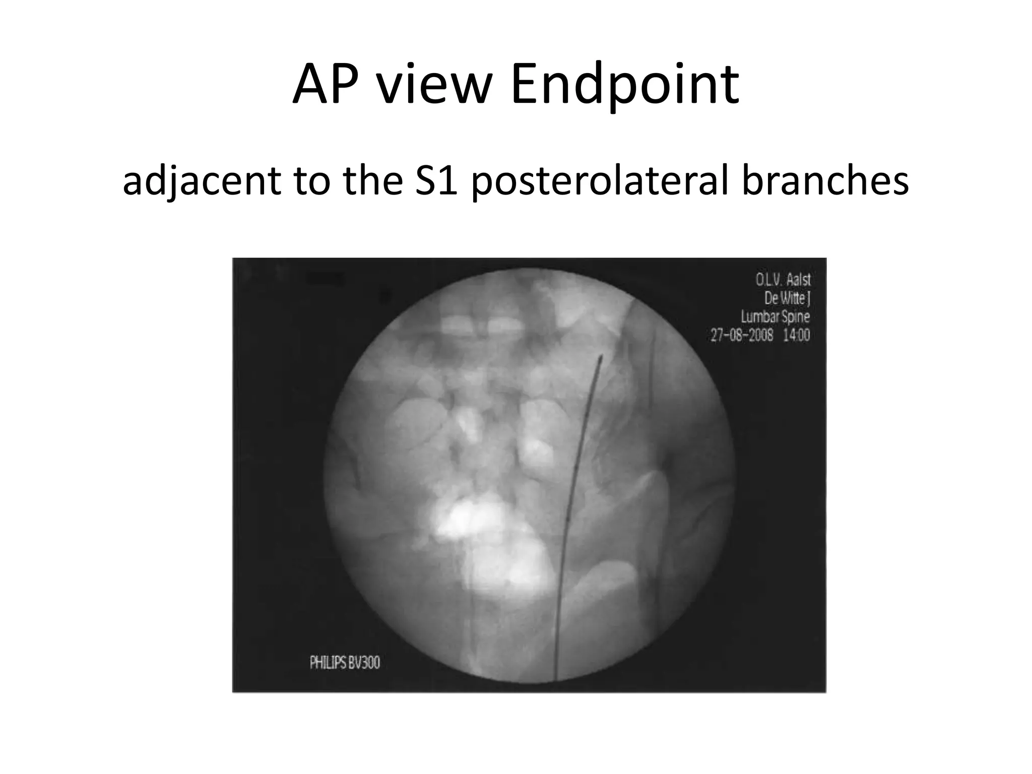 AP view Endpoint
adjacent to the S1 posterolateral branches
 