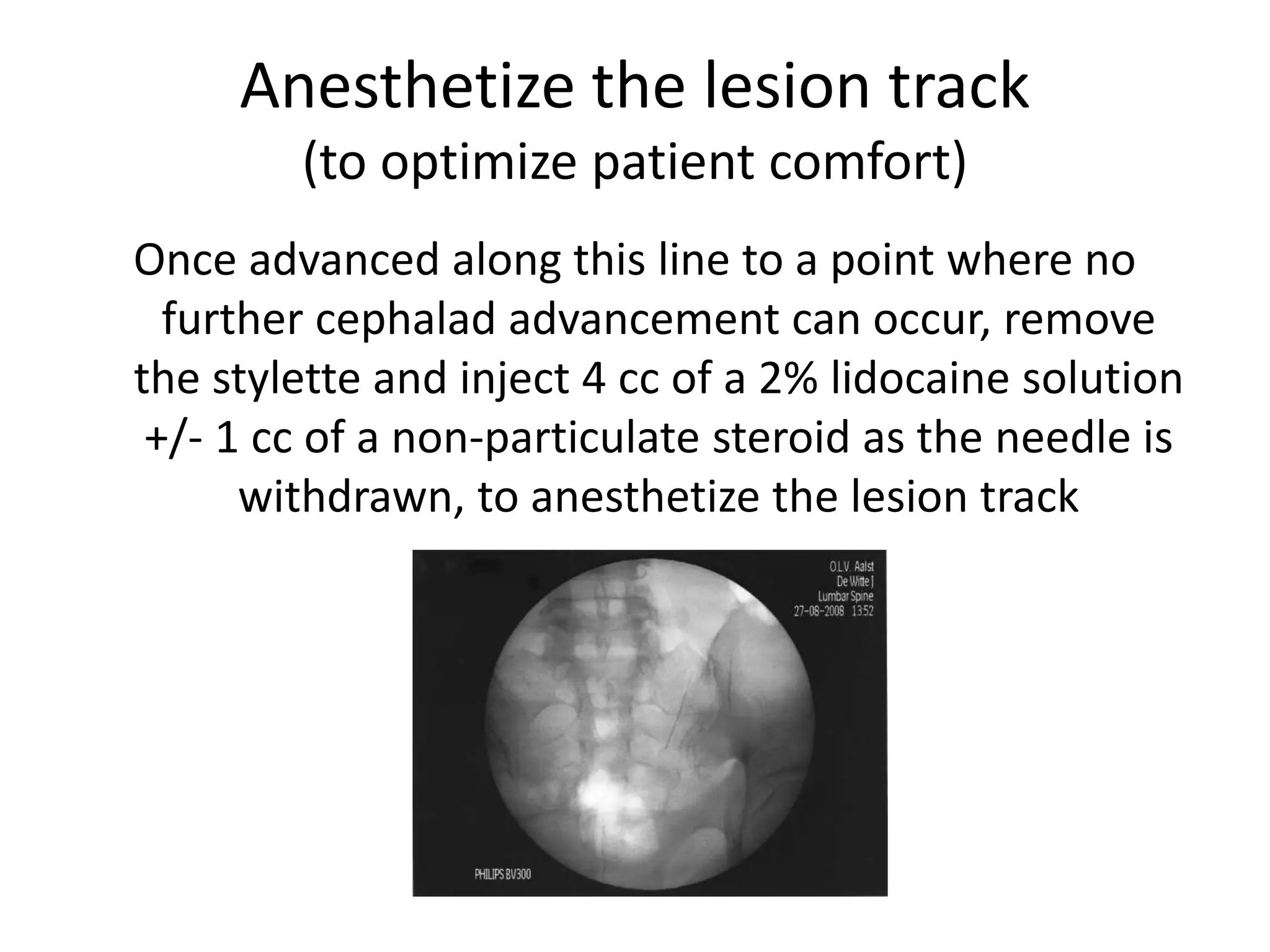 Anesthetize the lesion track
(to optimize patient comfort)
Once advanced along this line to a point where no
further cephalad advancement can occur, remove
the stylette and inject 4 cc of a 2% lidocaine solution
+/- 1 cc of a non-particulate steroid as the needle is
withdrawn, to anesthetize the lesion track
 