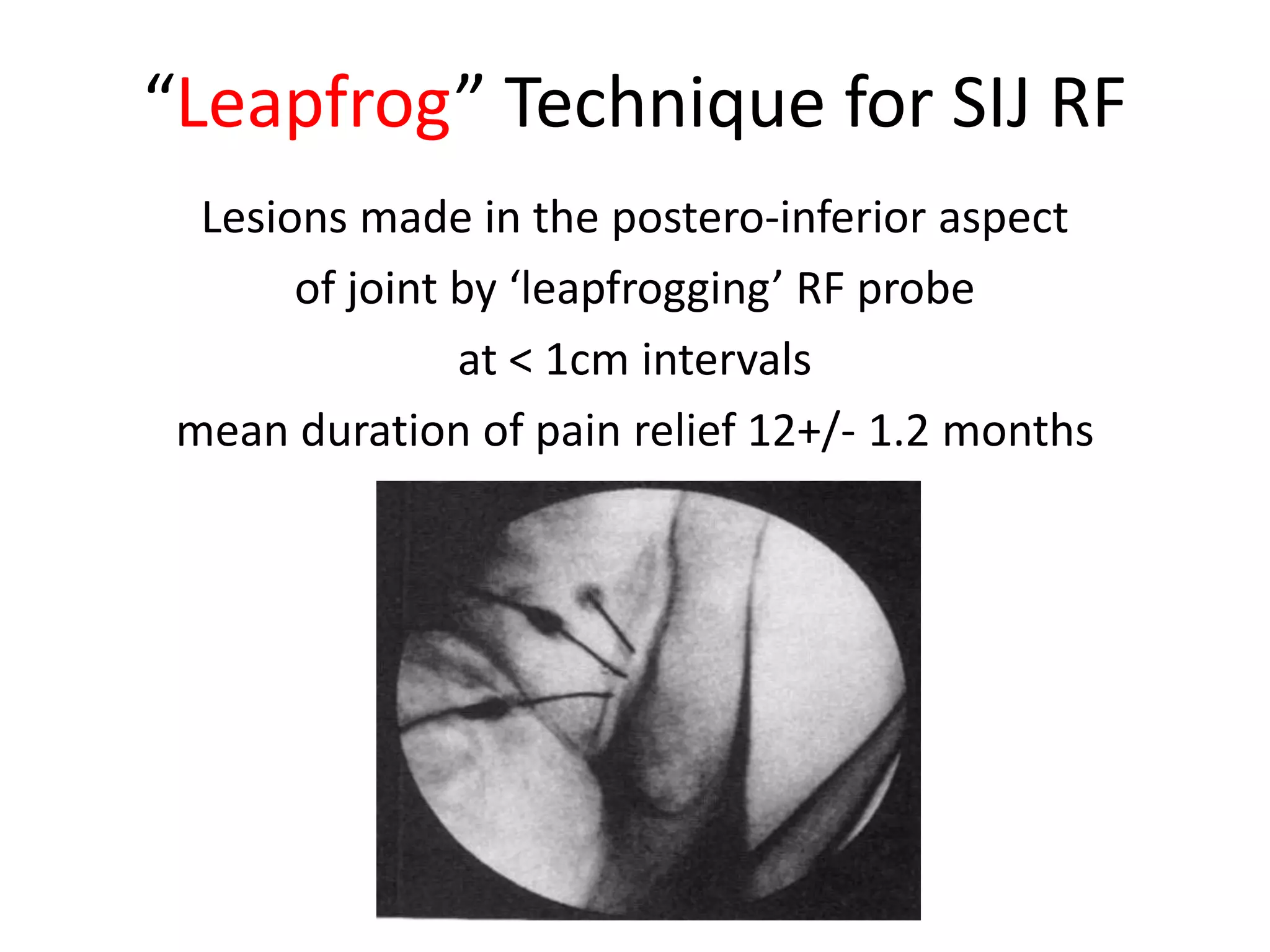 “Leapfrog” Technique for SIJ RF
Lesions made in the postero-inferior aspect
of joint by ‘leapfrogging’ RF probe
at < 1cm intervals
mean duration of pain relief 12+/- 1.2 months
 