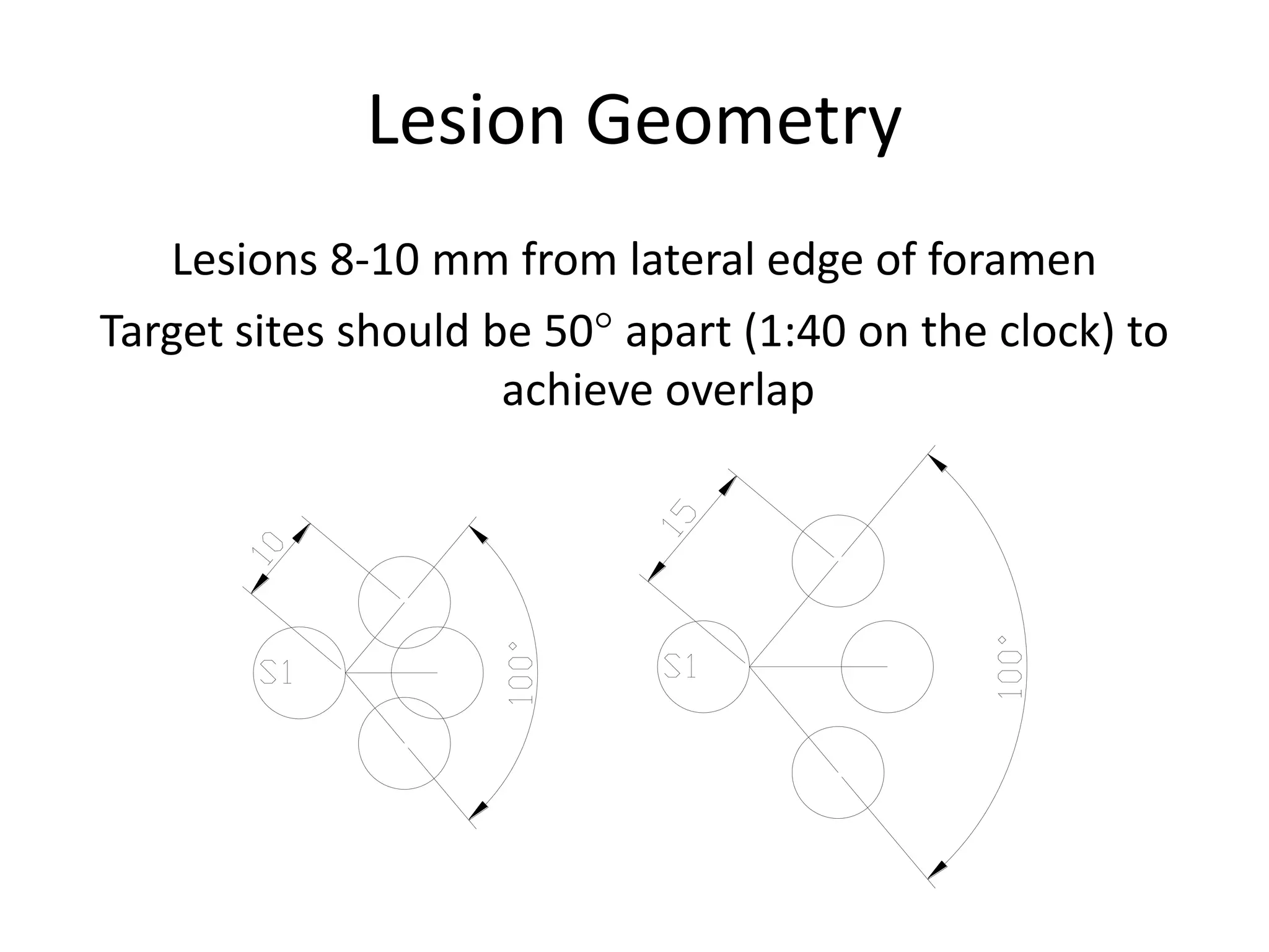 Lesion Geometry
Lesions 8-10 mm from lateral edge of foramen
Target sites should be 50° apart (1:40 on the clock) to
achieve overlap
 