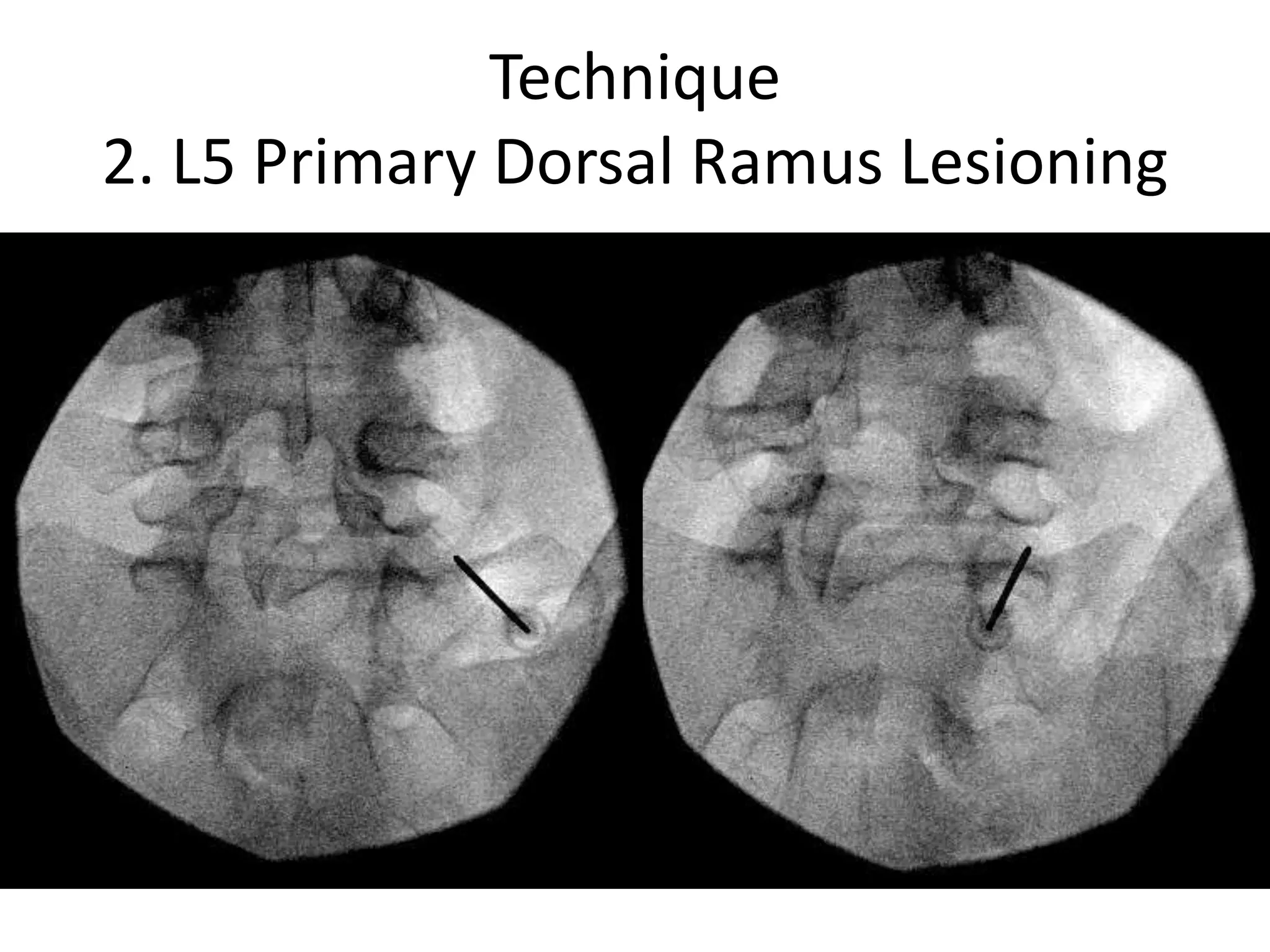 Technique
2. L5 Primary Dorsal Ramus Lesioning
 
