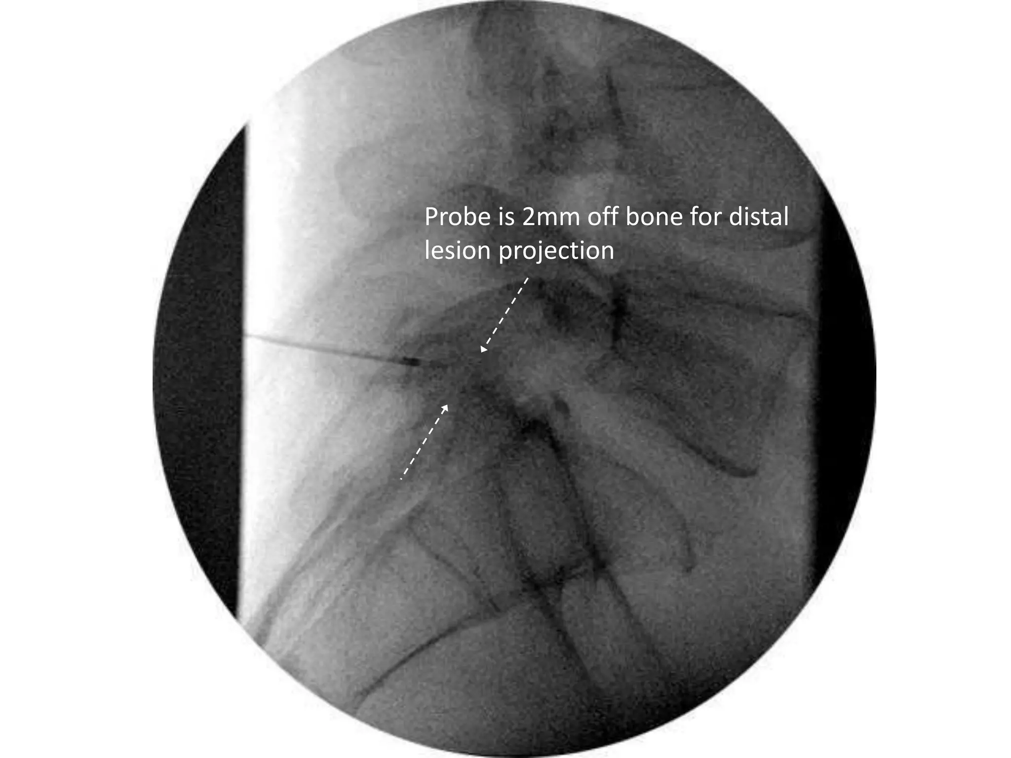 Probe is 2mm off bone for distal
lesion projection
 
