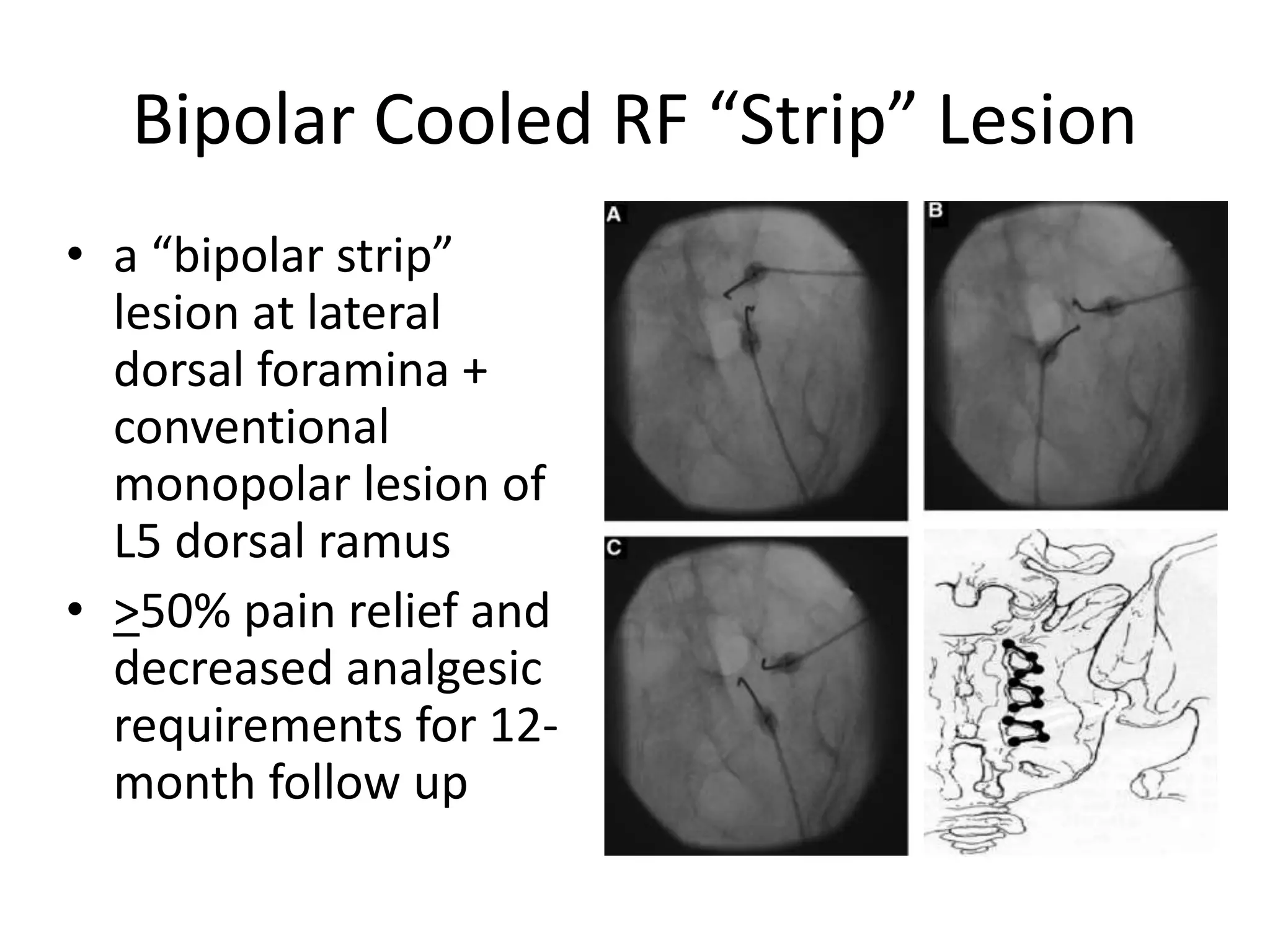 Bipolar Cooled RF “Strip” Lesion
• a “bipolar strip”
lesion at lateral
dorsal foramina +
conventional
monopolar lesion of
L5 dorsal ramus
• >50% pain relief and
decreased analgesic
requirements for 12-
month follow up
 