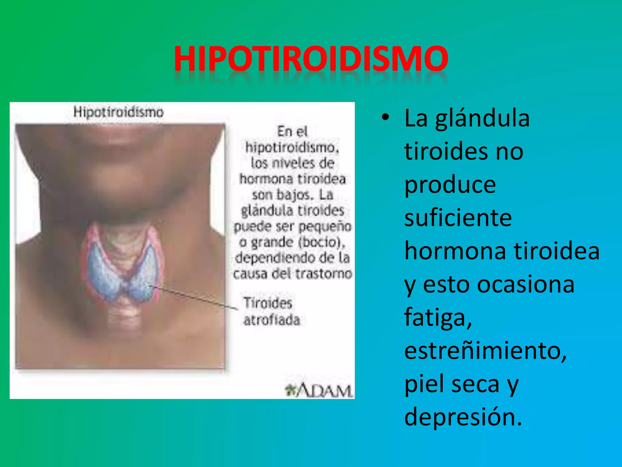 • La glándula
tiroides no
produce
suficiente
hormona tiroidea
y esto ocasiona
fatiga,
estreñimiento,
piel seca y
depresión.
 