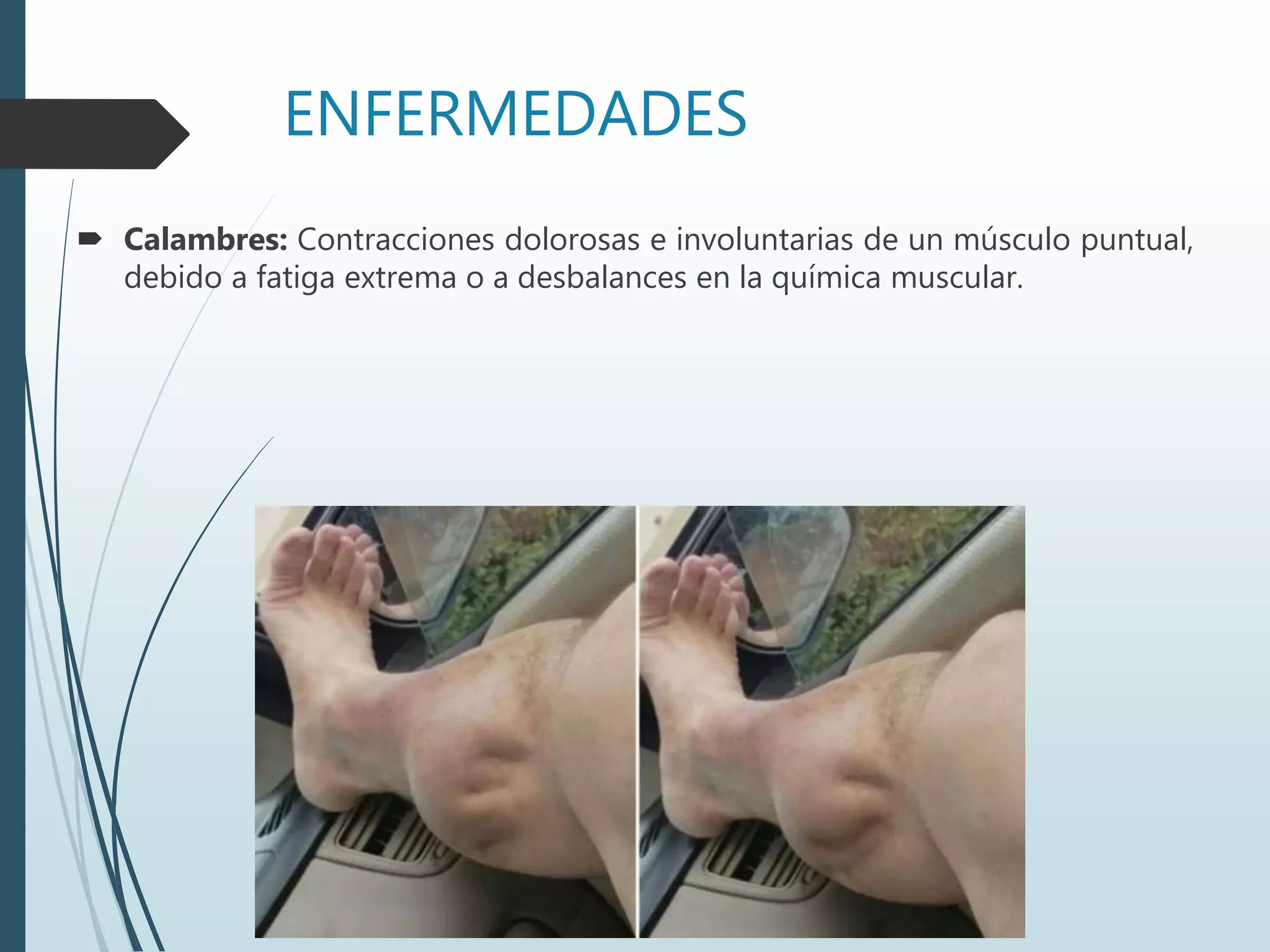 ENFERMEDADES
 Calambres: Contracciones dolorosas e involuntarias de un músculo puntual,
debido a fatiga extrema o a desbalances en la química muscular.
 