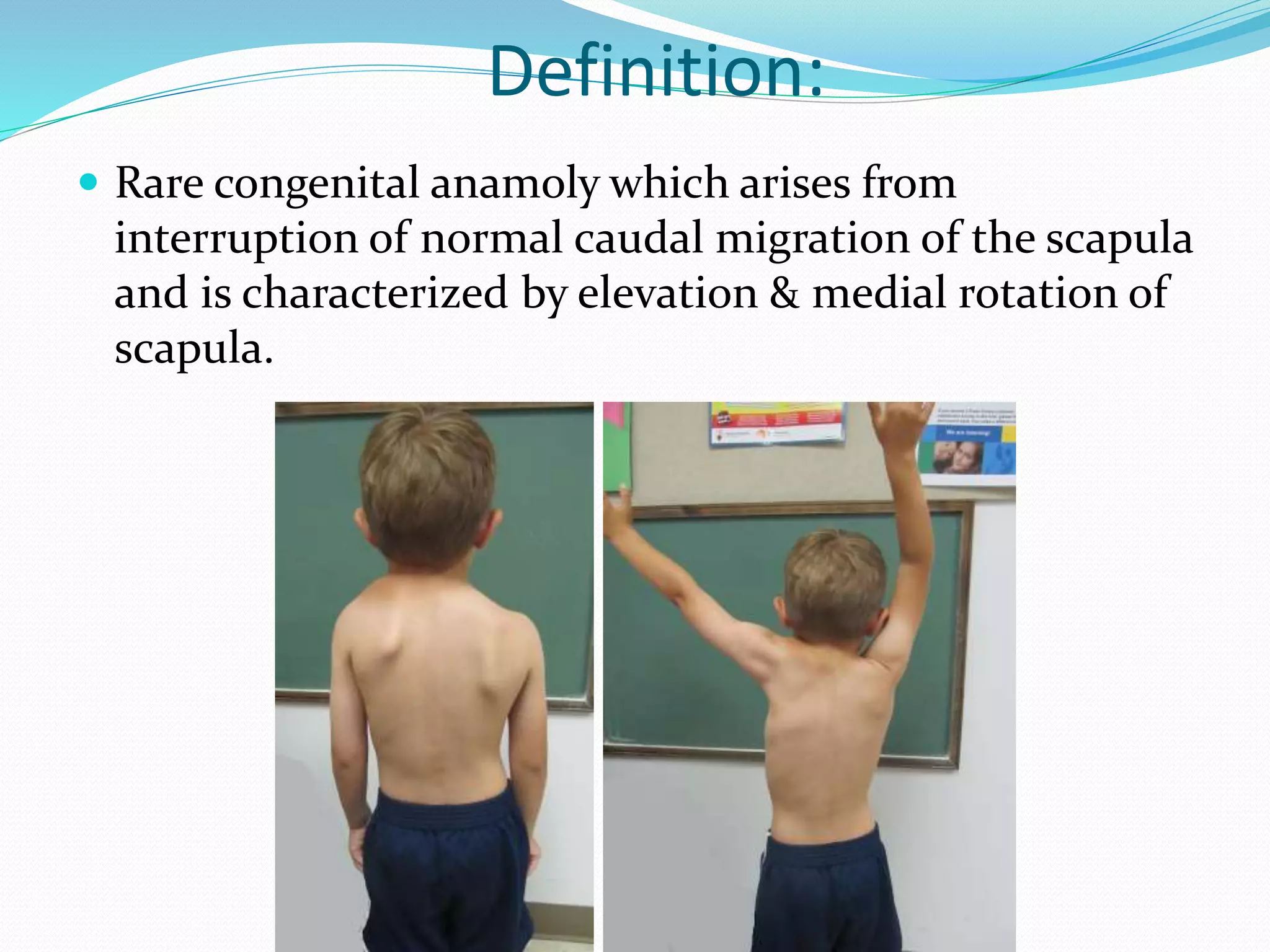 Definition:
 Rare congenital anamoly which arises from
interruption of normal caudal migration of the scapula
and is characterized by elevation & medial rotation of
scapula.
 