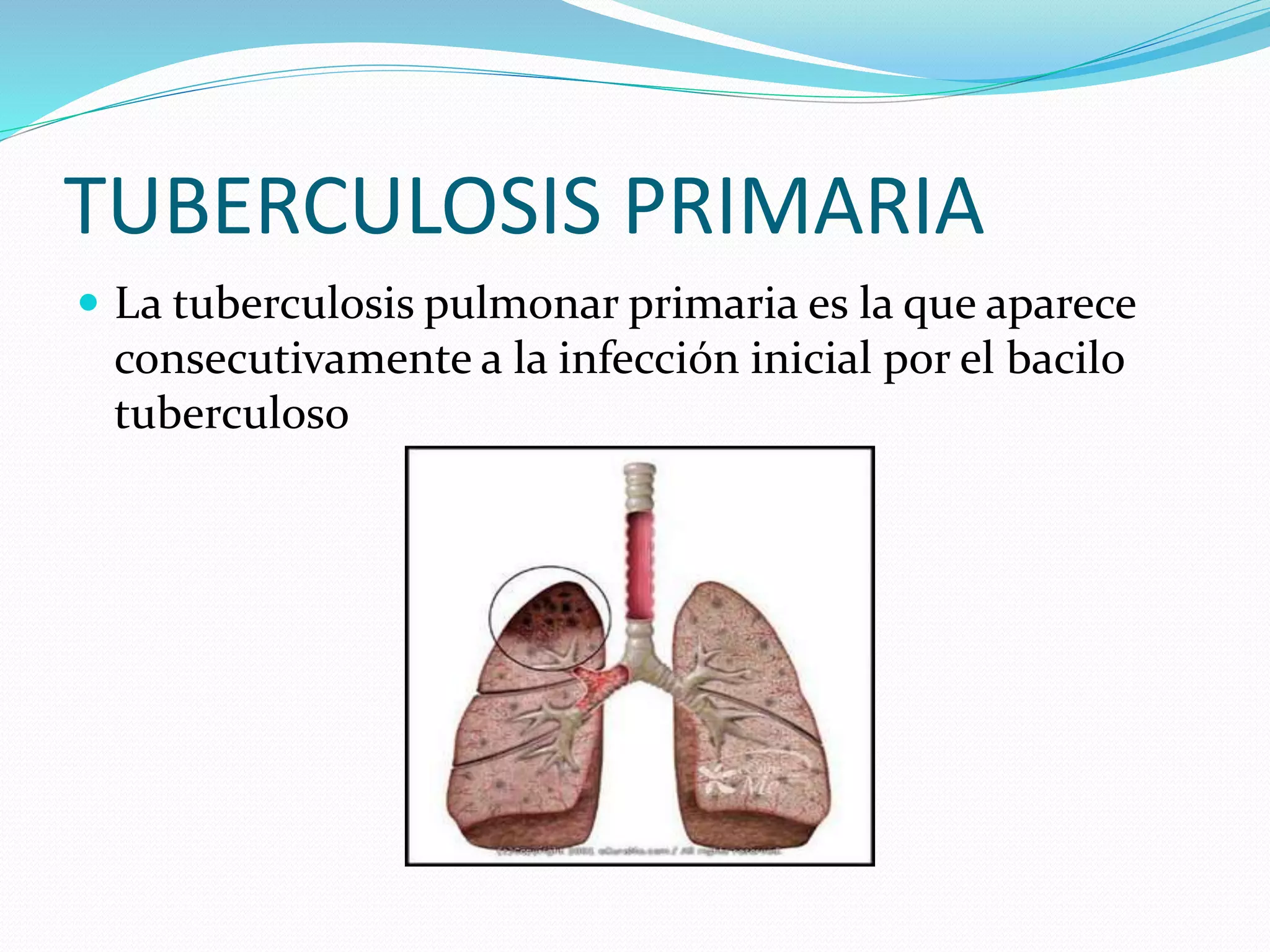 TUBERCULOSIS PRIMARIA
 La tuberculosis pulmonar primaria es la que aparece
consecutivamente a la infección inicial por el bacilo
tuberculoso
 