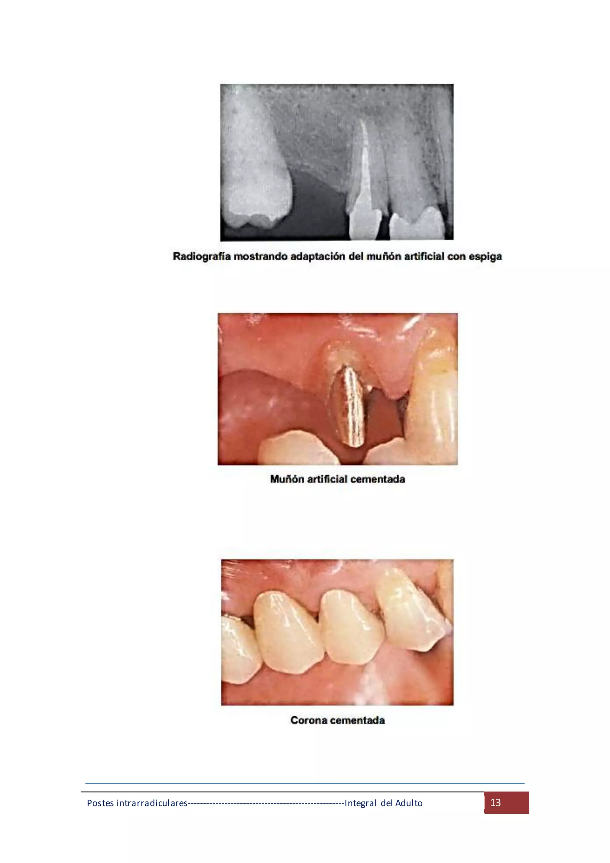 Postes intrarradiculares---------------------------------------------------Integral del Adulto 13
 