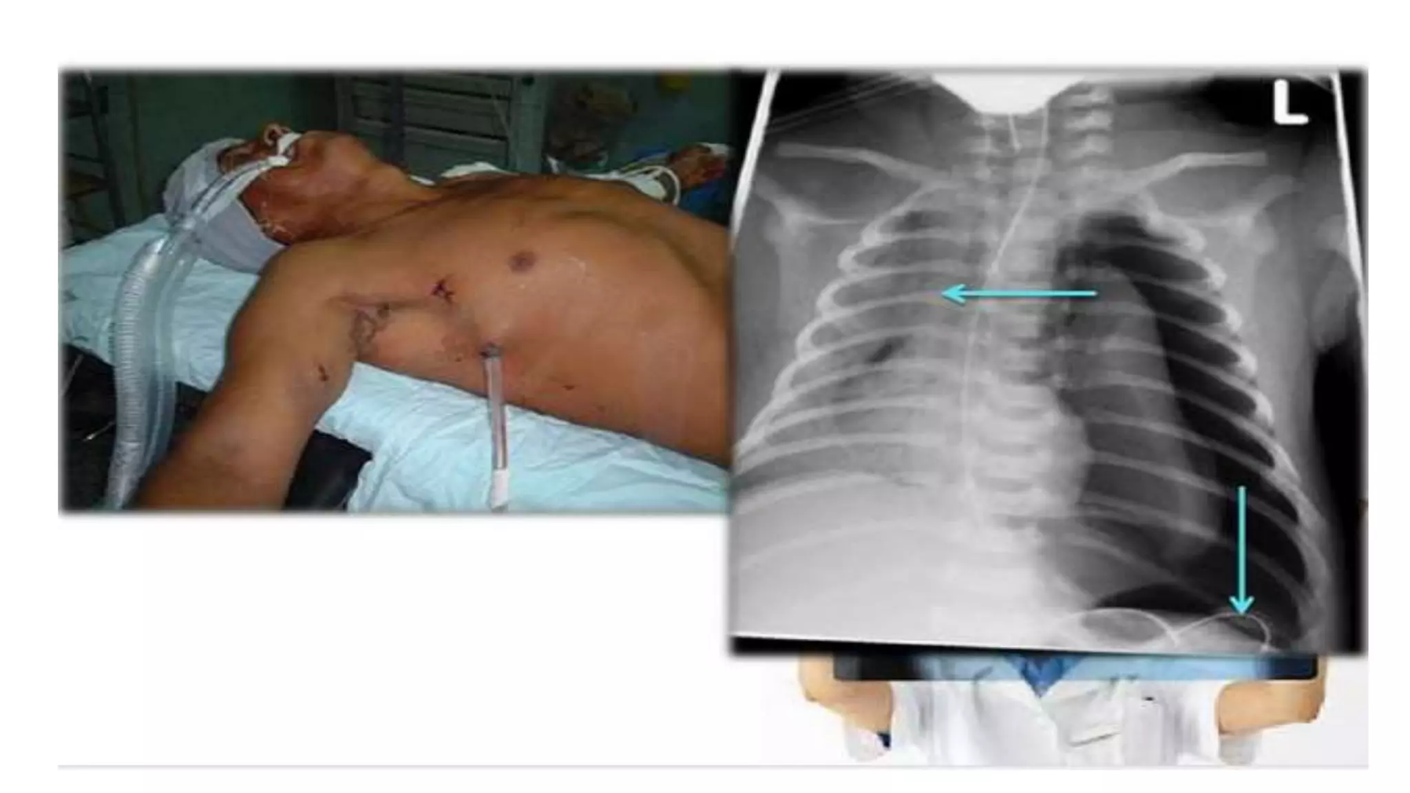 Traumatismo de torax