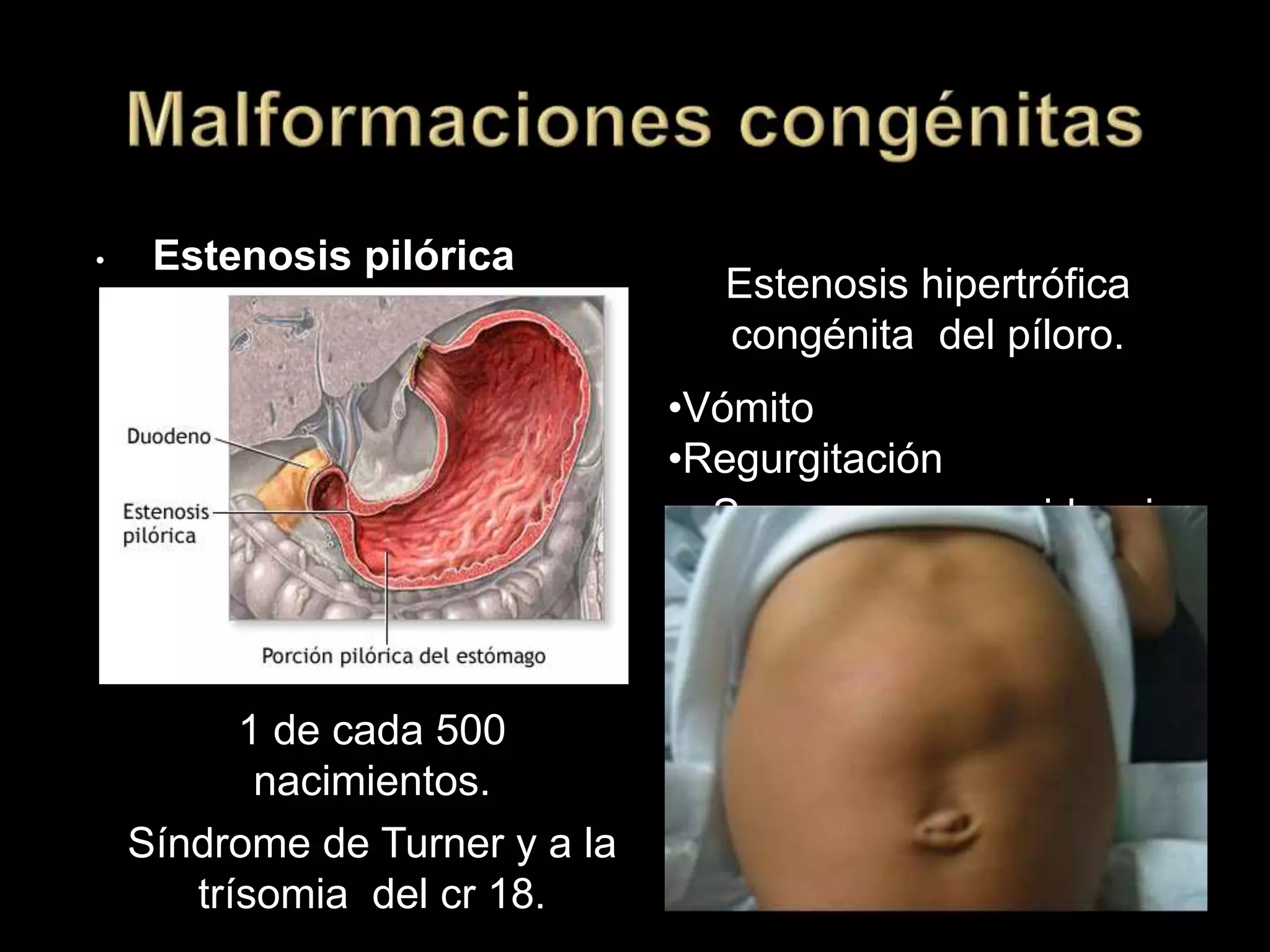 • Estenosis pilórica
1 de cada 500
nacimientos.
Síndrome de Turner y a la
trísomia del cr 18.
•Vómito
•Regurgitación
Estenosis hipertrófica
congénita del píloro.
•Se evidencia
peristaltismo desde el
exterior. Oliva pilórica.
•Masa ovoidea firme
palpable, área
estomacal.
 