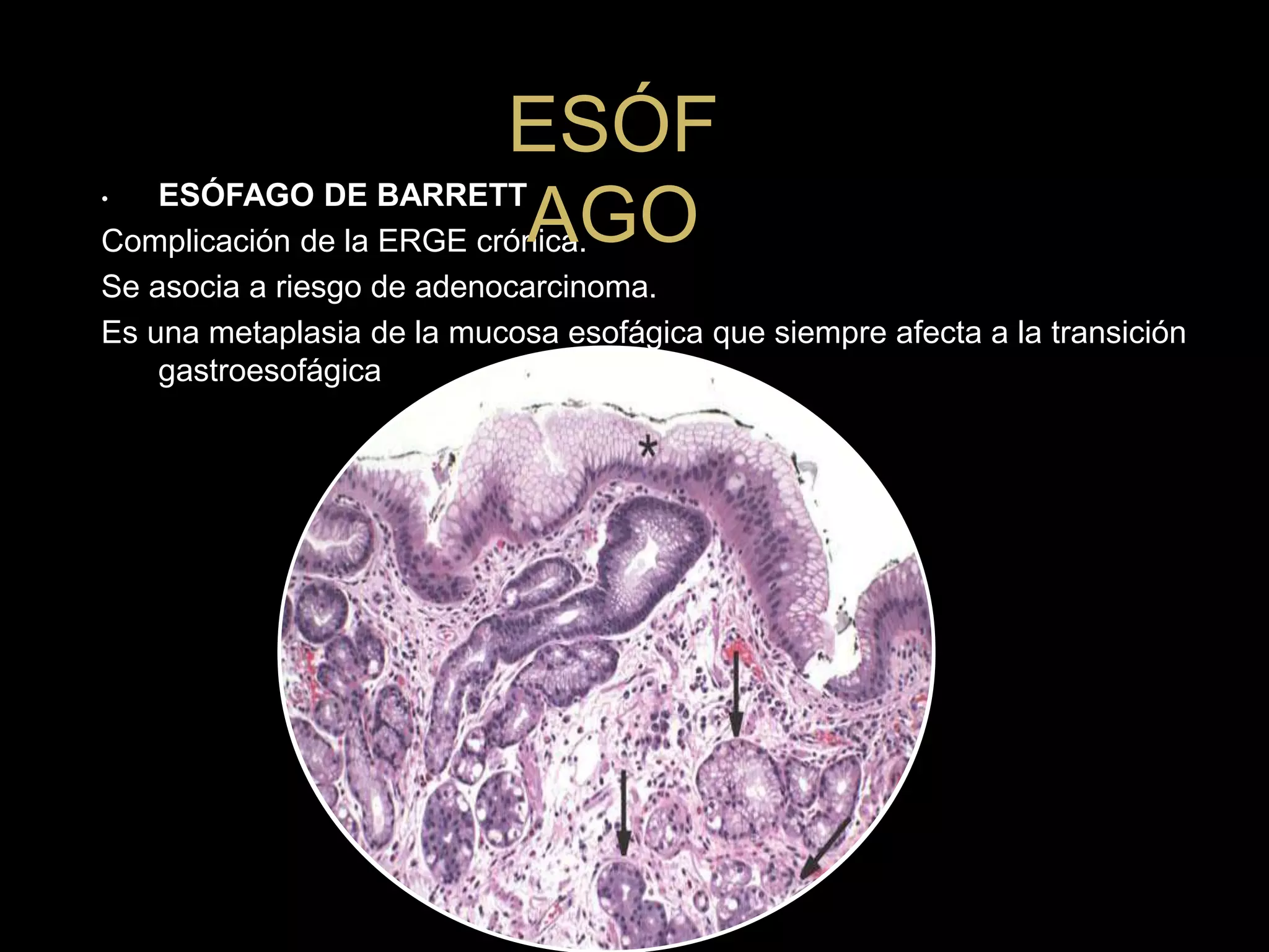 • ESÓFAGO DE BARRETT
Complicación de la ERGE crónica.
Se asocia a riesgo de adenocarcinoma.
Es una metaplasia de la mucosa esofágica que siempre afecta a la transición
gastroesofágica
ESÓF
AGO
 