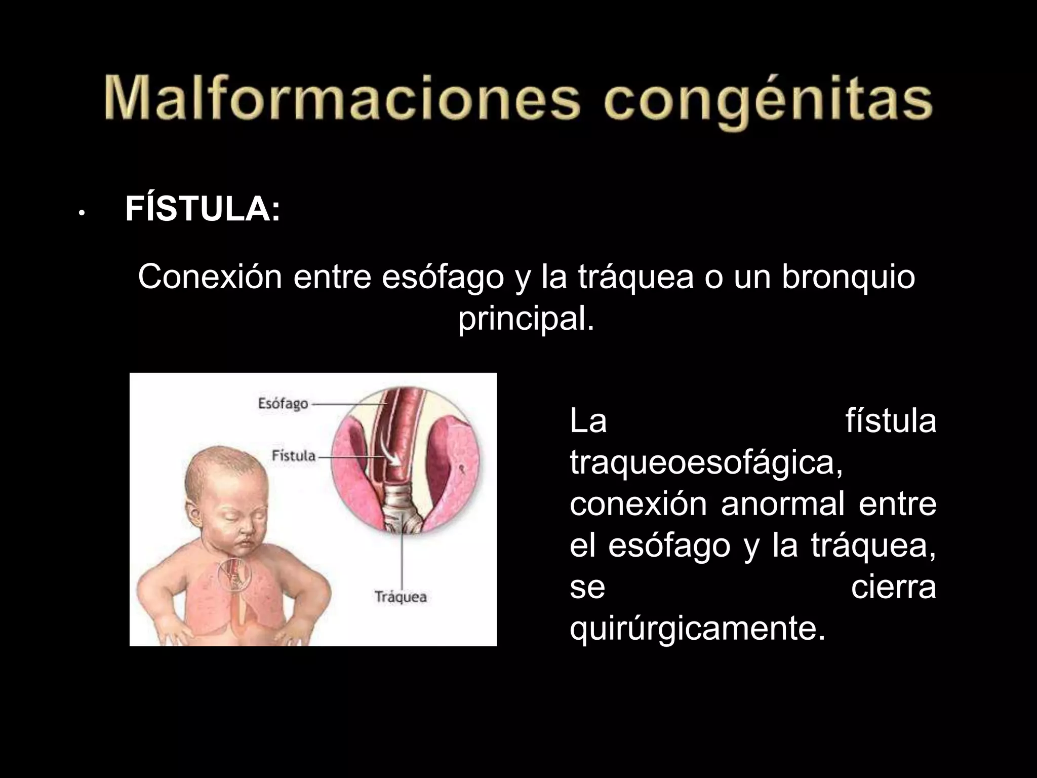 • FÍSTULA:
Conexión entre esófago y la tráquea o un bronquio
principal.
La fístula
traqueoesofágica,
conexión anormal entre
el esófago y la tráquea,
se cierra
quirúrgicamente.
 