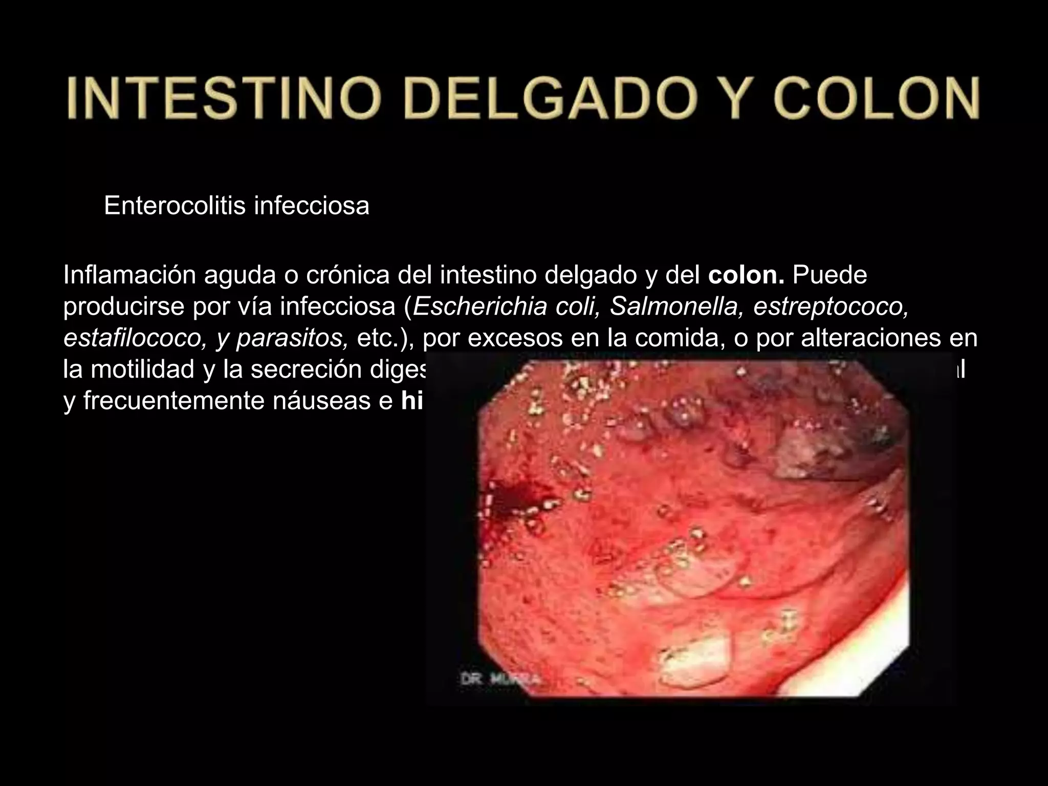 Enterocolitis infecciosa
Inflamación aguda o crónica del intestino delgado y del colon. Puede
producirse por vía infecciosa (Escherichia coli, Salmonella, estreptococo,
estafilococo, y parasitos, etc.), por excesos en la comida, o por alteraciones en
la motilidad y la secreción digestiva. Suele provocar diarreas, dolor abdominal
y frecuentemente náuseas e hipertermia.
 