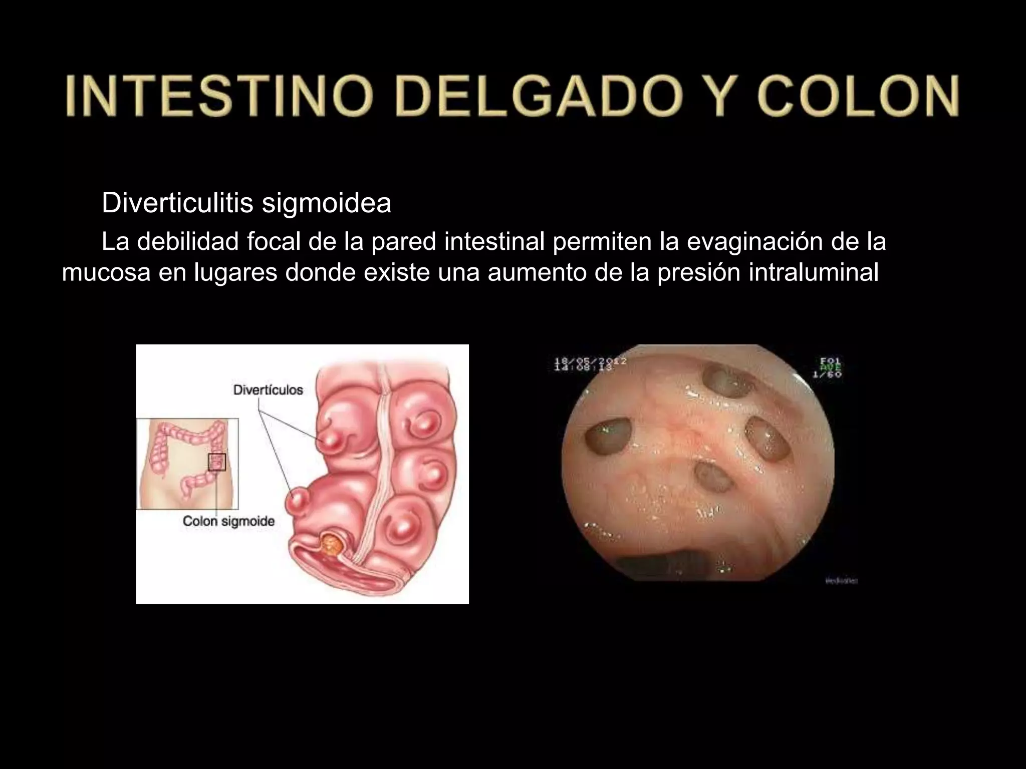 Diverticulitis sigmoidea
La debilidad focal de la pared intestinal permiten la evaginación de la
mucosa en lugares donde existe una aumento de la presión intraluminal
 