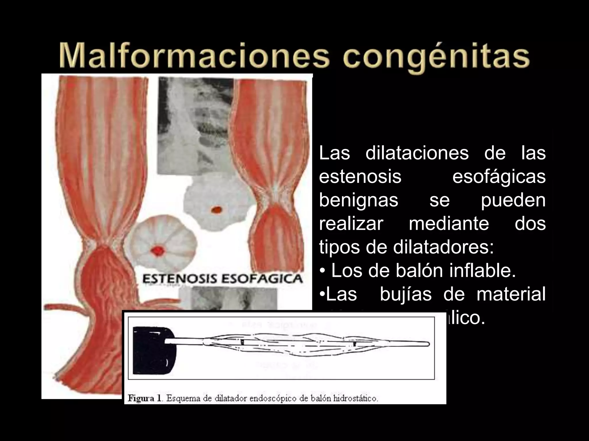  ESTENOSIS
Congénita o 2ria a cicatrización inflamatoria
Pared fibrosa engrosada
Luz reducida
Forma incompleta de atresiaLas dilataciones de las
estenosis esofágicas
benignas se pueden
realizar mediante dos
tipos de dilatadores:
• Los de balón inflable.
•Las bujías de material
plástico o metálico.
 