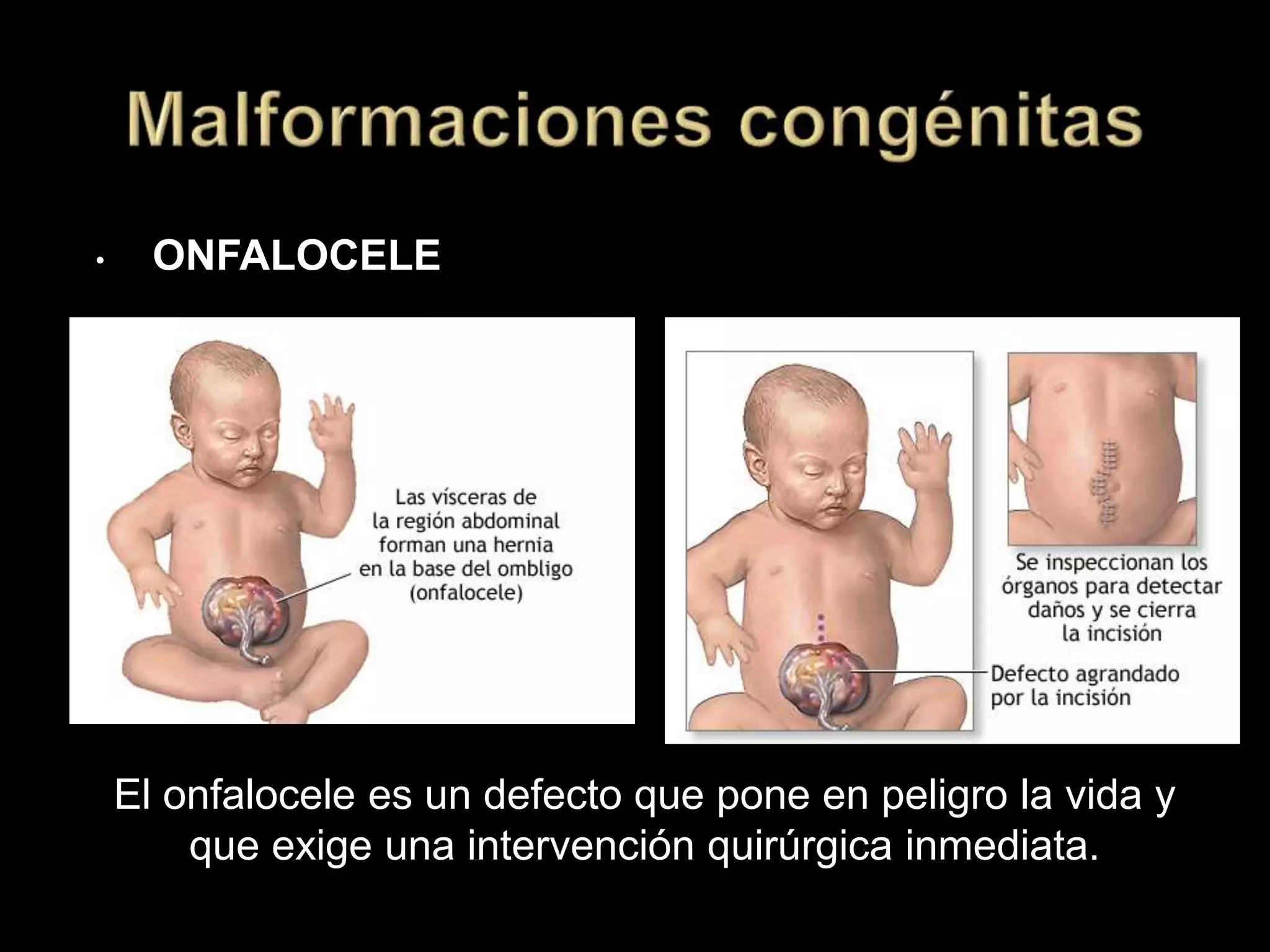 • ONFALOCELE
El onfalocele es un defecto que pone en peligro la vida y
que exige una intervención quirúrgica inmediata.
 