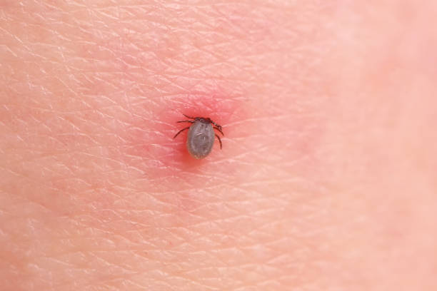 The tick bites the person, sucked deep under the skin.