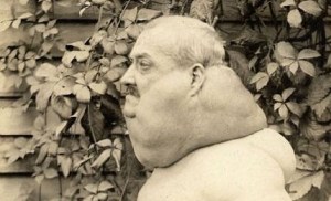 goiter dude