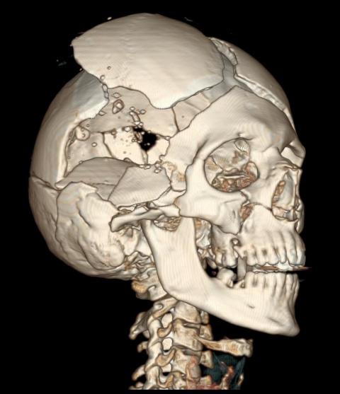 CT reconstruction of skull with bullet holes. Courtesy of the National Library of Medicine