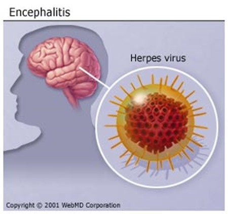 viral-encephalitis-15997_0 viral-encephalitis-15997_0