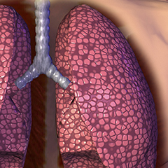 Tumore al polmone Tumore al polmone